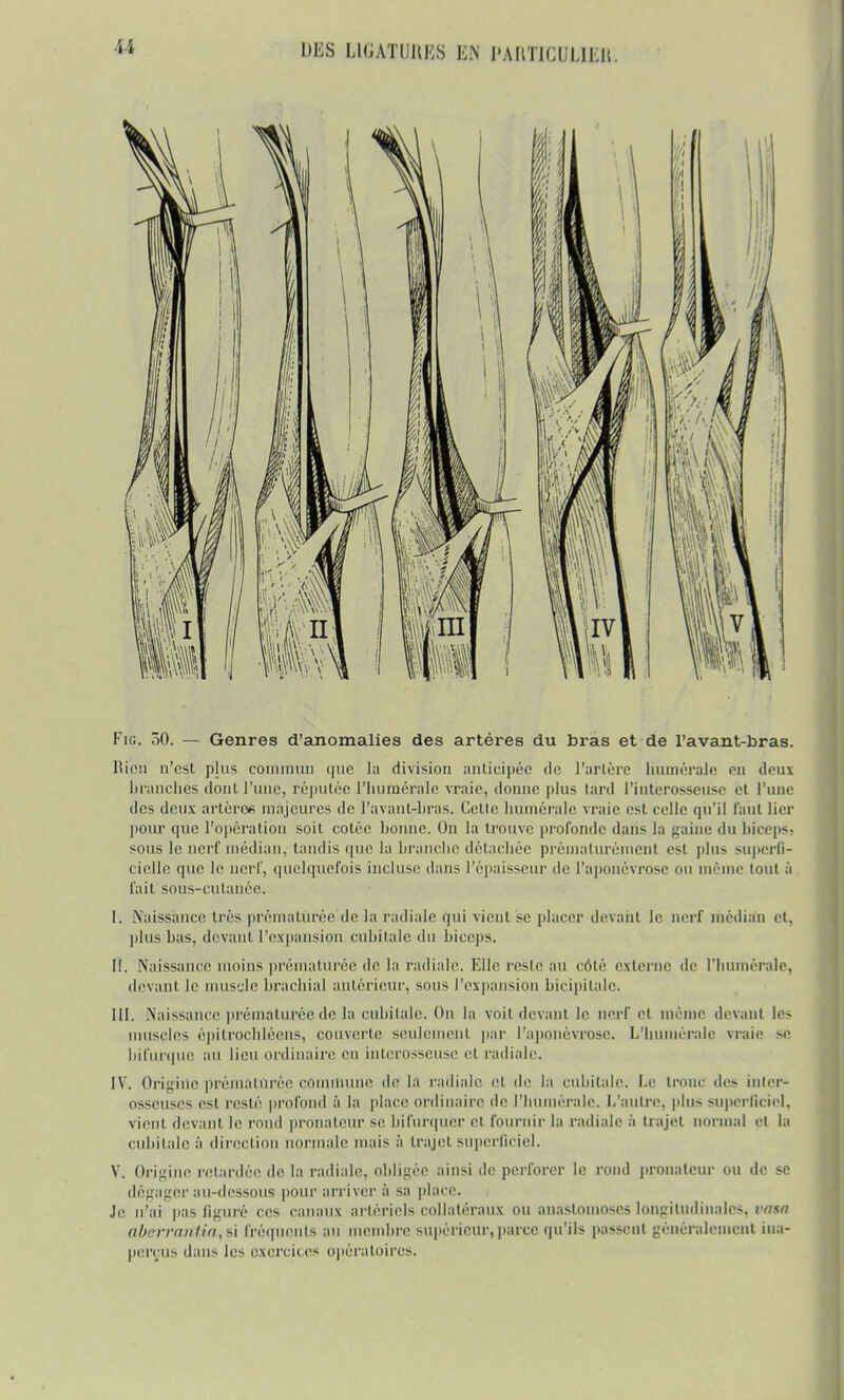 Fig. ôO. — Genres d'anomalies des artères du bras et de l'avant-bras. Ripn n'est plus commun que la division anticipée de l'artère liumérale en deux branches dont l'une, réputée l'humérale vraie, donne plus tard l'interosseuse et l'une des deux artères majeures de l'avant-bras. Celle liumérale vraie est celle qu'il faut lier pour que l'opération soit cotée bonne. On la trouve profonde dans la gaine du biceps, sous le nerf médian, tandis que la branche détachée prématurément est plus superfi- cielle que le nerf, quelquefois incluse dans l'épaisseur de l'aponévrose mi même tout à fait sous-cutanée. [. Naissance 1res prématurée de la radiale qui vient se placer devant le nerf médit I, plus bas, devant l'expansion cubitale du biceps. II. Naissance moins prématurée de la radiale. Elle reste au côté externe de l'humérale, devanl le muscle brachial antérieur, sous l'expansion bicipitale. III. .Naissance prématurée de la cubitale. On la voit devant le nerf el même devant les muscles êpitiochléens, couverte seulemenl par l'aponévrose. L'humérale vraie se bifurque au lieu ordinaire en interosseuse el radiale. IV. Origine prématurée commune de la radiale et de la cubitale. Le tronc des inler* osseuses est resté profond à la place ordinaire de rimmérale. L'autre, plus superficiel, vient devant le rond pronateur si; bifurquer et fournir la radiale à trajet normal et la cubitale à direction normale mais & trajel superficiel. V. Origine retardée de la radiale, obligée ainsi de perforer le rond pronateur ou de se dégager au-dessous pour arrivera sa place. .le n'ai pas figuré ces canaux artériels collatéraux ou anastomoses longitudinales, vasa abertaiftia,i\ fréquents au membre supérieur,parce qu'ils passent généralement ina- perçus dans les exercices opératoires.