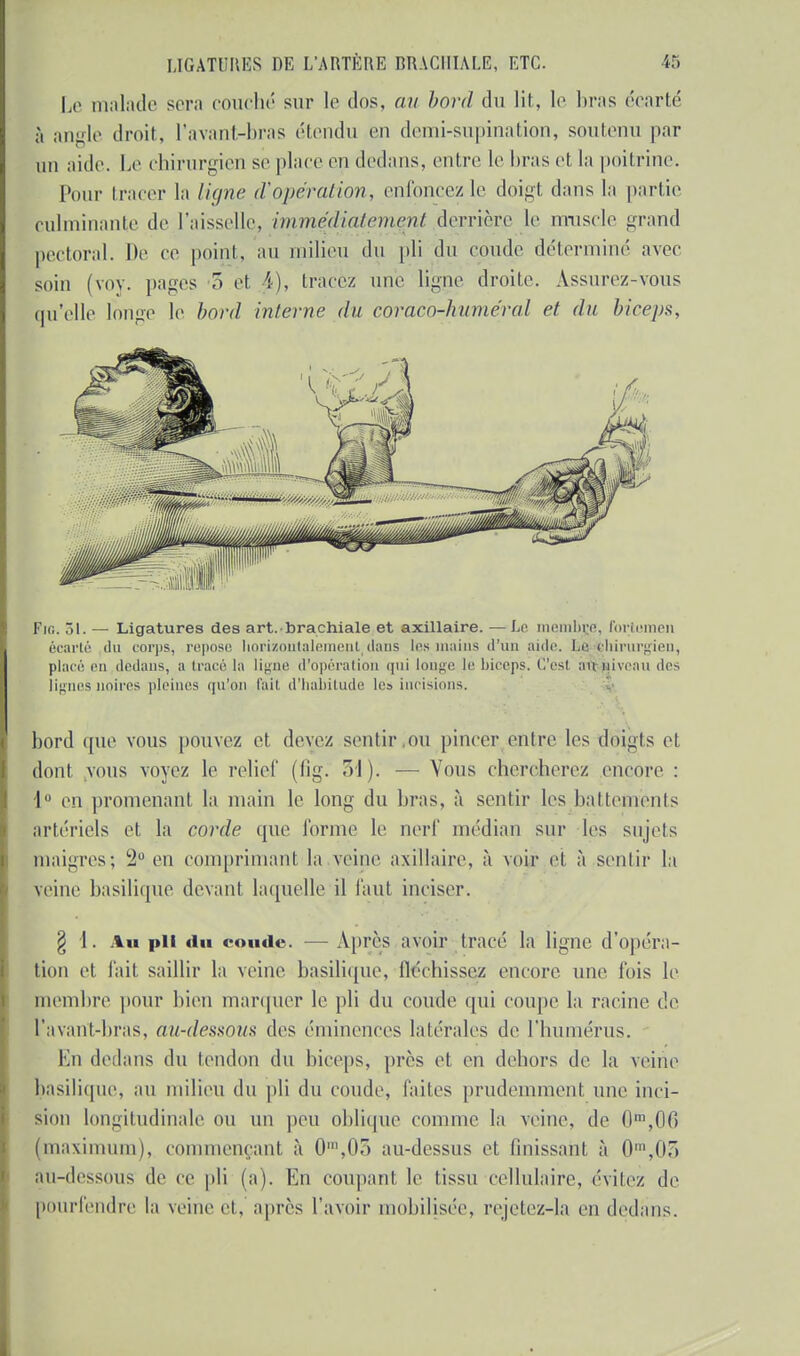 Le malade sera couché sur le dos, au bord du lit, le bras écarté à angle droit, l'avant-bras étendu en demi-supination, soutenu par un aide. Le chirurgien se place en dedans, entre le liras et la poitrine. Pour tracer la ligne d'opération, enfoncez le doigt dans la partie culminante de l'aisselle, immédiatement derrière le muscle grand pectoral. De ce point, au milieu du pli du coude déterminé avec soin (vov. pages 3 et 4), tracez une ligne droite. Assurez-vous qu'elle longe le bord interne du coracb-huméral et du biceps, Fu;. 51. — Ligatures des art. brachiale et axillaire. — Le membre, fortomen écarté du corps, repose horizontalement dans les mains d'un aide. Le Chirurgien, placé en dedans, a tracé la ligne d'opération qui longe le biceps, C'est ait niveau des lignes noires pleines qu'on (ail d'habitude les incisions, bord que vous pouvez et devez sentir ou pincer entre les doigts et dont, vous voyez le relief (lig. 31). — Vous chercherez encore : I en promenant la main le long du bras, à sentir les battements artériels et la corde que forme le nerf médian sur les sujets maigres; 2° eu comprimant la veine axillaire, à voir et à sentir la veine basilique devant laquelle il faut inciser. § 1. Au pli du coude. — Après avoir tracé la ligne d'opéra- tion et l'ait saillir la veine basilique, fléchissez encore une fois le membre pour bien marquer le pli du coude qui coupe la racine de l'avant-bras, au-dessous des emmenées latérales de l'humérus. En dedans du tendon du biceps, près et en dehors de la veine basilique, au milieu du pli du coude, faites prudemment une inci- sion longitudinale ou un peu oblique comme la veine, de 0m,0f) (maximum), commençant à 0\05 au-dessus et finissant à 0m,0o au-dessous de ce pli (a). En coupant le tissu cellulaire, évitez de pourfendre la veine et, après l'avoir mobilisée, rejetez-la en dedans.