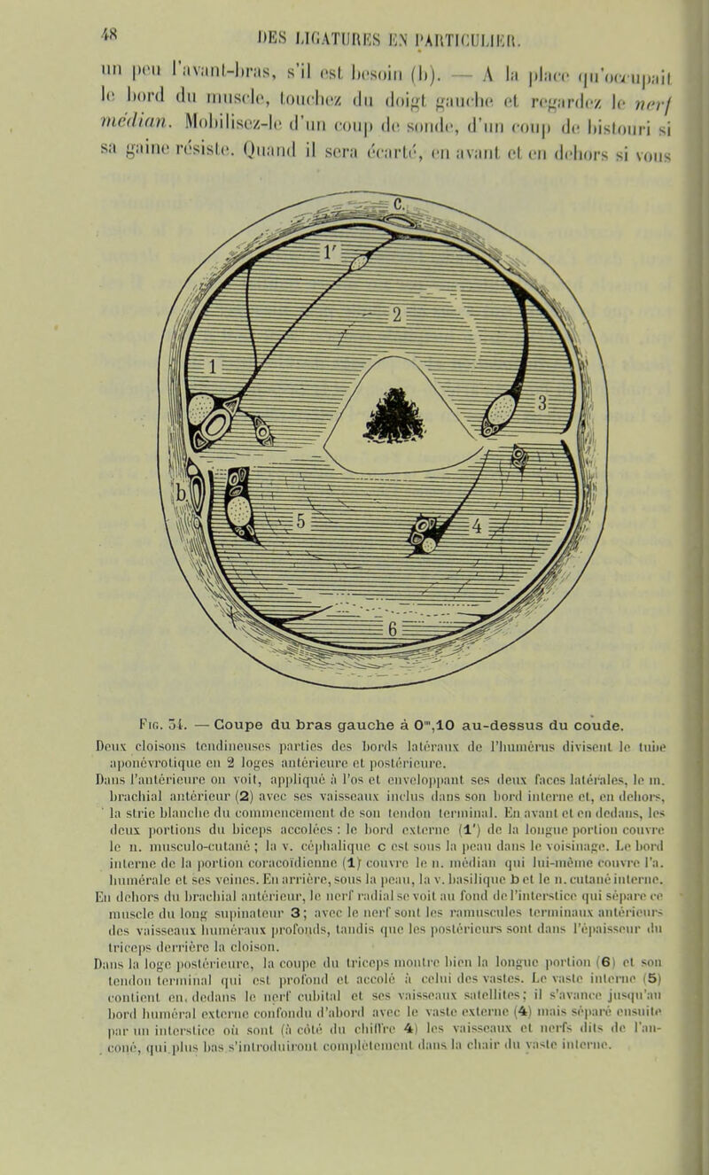 mi peu l'a^amlHbras, s'il est besoin (l>). A la place qu'occupai* le bord du muscle, louchez du doigt gauche et. regardez le nerf médian. Moliilisiv.-lc d'un coup <l.- sonde-, d'un coup de bistouri si sa gaine résisle. Quand il sera écartr, eu avant cl eu dehors si vous Fin. 54. — Coupe du bras gauche à 0,10 au-dessus du coude. Doux cloisons tendineuses parties des bords latéraux de L'humérus divisent le tube aponévrotique en -1 lo^es antérieure el postérieure, Dans l'antérieure on voit, appliqué ;'i l'os et enveloppant ses deux faces latérales, le m. brachial antérieur (2) avec ses vaisseaux inclus dans son bord interne et, en dehors, ' la strie blanche du commencement de son tendon terminal. En avant el en dedans, les deux portions du biceps accolées : le boni externe (1') de la longue portion couvre le n. musculo-cutané ; la v. céphalique c est sous la peau dans le voisinage. Le bord interne de la portion coracoïdienne {1) couvre le n. médian qui lui-même couvre l'a. numérale et ses veines. En arriére, sous la peau, la v. basilique b et le n. cutané interne. En dehors du brachial antérieur, b' nerf radial se voit au fond de l'interstice qui sépare ce muscle du Ions supinateur 3; avec le nerf sont les ramuscules terminaux antérieurs des vaisseaux (minéraux profonds, taudis que les postérieurs sont dans l'épaisseur du triceps derrière la cloison. Dans la loge postérieure, la coupe du triceps montre bien la longue portion (6] el son tendon terminal qui est profond el accolé à celui des vastes. Le vaste interne (5) contient eu. dedans le nerf cubital et ses vaisseaux satellites: il s'avance'jusqu'au bord huméral externe confondu d'abord avec le vaste externe (4) mais séparé ensuite par un interstice où sont (à coté du chiffre 4k) les vaisseaux et nerfs dits de Pan- Cône., qui plus bas s'introduiront complètement dans la chair du va-le inlerne.