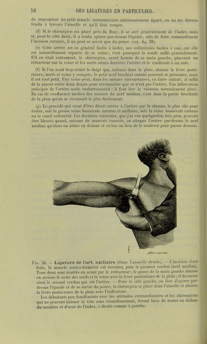 do rencontrer un petit muscle s uni braire antérieurement liguré, ou un arc Obreux tondu à Ira vers l'aisselle cl qu'il faut couper. (d) Si le chirurgien est placé près du Oanc, il se sort généralement de l'index, mais si, pour'le oôté droit, il a voulu opérer par-dessus l'épaule, afin de Caire commodément l'incision cutanée, il nu peut si; servir que du pouce (voy. lig. ~>Hj. (o) Cotte artère est en général facile à isoler, ses collatérales faciles à voir, car elle est naturellement séparée de sa veine; c'est pourquoi la sonde suffit généralement. S'il en était autrement, le Chirurgien, ayant bOMin de sa main gaucho, placerait uu rétracteur sur la veine et les nerfs situés derrière l'artère cl le confierait à un aide. (f) Si l'on avait trop relire le doigt qui, enfoncé dans la plaie, abaisse la lèvre posté- rieure, nerfs et veine y compris, le petit nerf brachial cutané pourrai) se présenter, mail il est tout petit. Une veine peut, dans les mêmes circonstances, en faire autant : il suffit de la pincer entre doux doigts pour reconnaître que ce n'est pas l'artère. Une bifurcation anticipée, de l'artère seule embarrasserait : il faut lier le vaisseau normalement placé. En cas de confluence tardive des racines du nerf médian, c'est dans la partie brachiale do la plaie qu'on se reconnaît le plus facilement. (g) Le procédé qui vient d'être décrit arrive à l'artère par le chemin le plus sùx pour éviter, soit la grosso veine numérale interne et oxillaire, soit la veine numérale externe ou le canal collatéral. Ces derniers vaisseaux, que j'ai vus quelquefois très gros, peuvent être blessés quand, suivant de mauvais conseils, on attaque l'artère par-dessus le nerf médian qu'alors on attire on dedans ot en bas au lieu de le soulever pour passer dessous. IV.. T>S. — Ligature de l'art, axillaire (dans l'aisselle droite).'— L'incision étant faite, le muscle coraco-buméral est. reconnu, puis le premier cordon (nerf médian). Tous deux sont écartés en avant par le rétracteur; le pouce de la main gauche abaissé on arrière le reste des nerfs (il la veine avec la lèvre postérieure de la plaie : il découvre ainsi le second cordon qui est l'artère. — Pour le côté gauche, au lieu d'opérer par- dessus l'épaule et de se servir du pouce, le chirurgien se place dans l'aisselle et abaisse la lèvre postéiieure de la plaie avec l'indicateur. Les débutants peu familiarisés avec les attitudes extraordinaires ot les chirurgiens «pli ne peuvent baisser la tète sans êlourdissoinent, feront bien de rester eu dedans du membre et d'user de l'index, à droite comme à gauche.