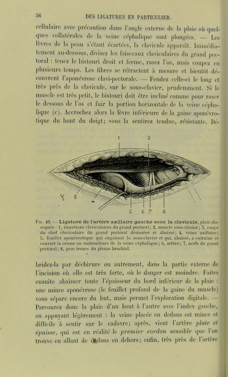 cellulaire avec précaution dans l'angle externe de la plaie oh quel- ques collatérales de la veine céphalique sont plongées. — Us lèvres de h peau s'étant écartées, la clavicule apparaît. Immédia- tement au-dessous, divisez les faisceaux elaviculaires du grand pec- toral : tenez le bistouri droit et. ferme, rasez l'os, niais coupez en plusieurs temps. Les libres se rétractent à mesure et bientôt dé- couvrent l'aponévrose clavi-peetorale. — Fendez celle-ci le long et très près de la clavicule, sur le sous-clavier, prudemment. Si le muscle est très petit, le bistouri doit être incliné comme pour raser le dessous de l'os et fuir la portion horizontale de la veine cépha- lique (c). Accrochez alors la lèvre inférieure de la gaine aponévro- tique du bout du doigt; vous la sentirez tendue, résistante. Dc- 1 2 Fie. 40. — Ligature de l'artère axillaire gauche sous la clavicule, plaie dis- séquée: 1, insertions elaviculaires du grand pectoral; 2, muscle sous-clavier; ô. coupe du clief claviculaire du grand pectoral désiuséré et abaissé; -i, veine axillaire; 5, feuillet aponéyrotiqu'e qui engainait le sous-clavier et qui, abaissé, a entraîné et couvert la crosse ou embouchure de la veine céphalique; 6, artère; 7, nerfs du grand pectoral; 8, gros troncs du plexus brachial. bridez-la par déchirure ou autrement, dans la partie externe de l'incision où elle est très forte, où le danger est moindre, laites ensuite abaisser toute l'épaisseur du bord inférieur de la plaie : une mince aponévrose (le feuillet profond de la gaine du muscle) vous sépare encore du but, mais permet l'exploration digitale. Parcourez donc la plaie d'un bout à l'autre avec l'index gauche, en appuyant légèrement : la veine placée en dedans est mince et difficile à sentir sur le cadavre; après, vient l'artère plate ri épaisse, (|ui est en réalité le premier cordon se7isibîe que l'on trouve en allant de dedans en dehors; enfin, très près de l'artère