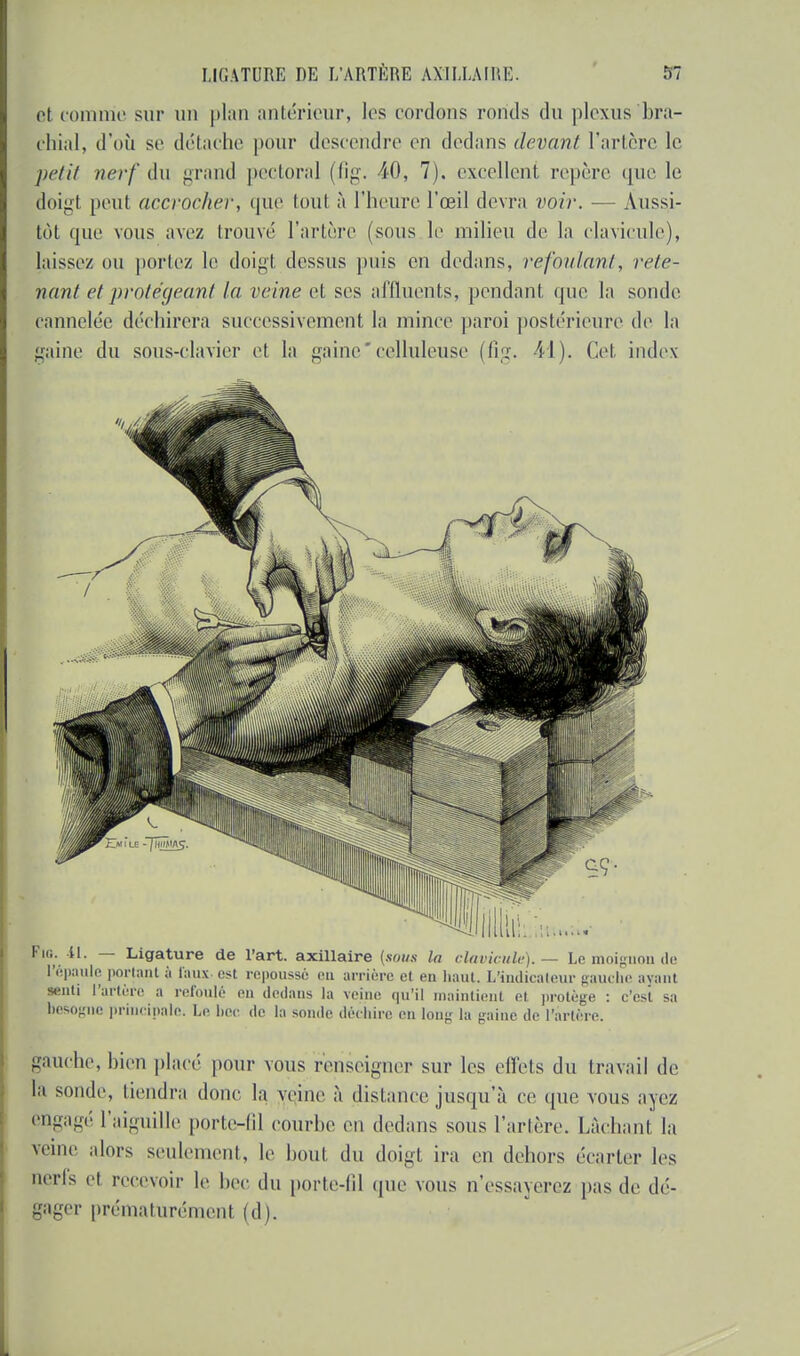 el comme sur un plan antérieur, les cordons ronds du plexus bra- chial, d'où se détache pour descendre en dedans devant l'artère le petit nerf du grand pectoral (fig. 40, 7), excellent repère que le doigt peut accroche)-, que tout à l'heure l'œil devra voir. — Aussi- tôt que vous avez trouvé l'artère (sous le milieu de la clavicule), laissez ou portez le doigt dessus puis en dedans, refoulant, rete- nant et protégeant la veine et ses affluents, pendant que la sonde cannelée déchirera successivement la mince paroi postérieure de la gaine du sous-clavier et la gainecelluleuse (fig. M). Cet index Fio. il. — Ligature de l'art, axillaire (sous la clavicule). — Le moignon de l'épaule portant à faux est repoussé eu arrière el en haut. L'indicateur gauche avant senti l'artère a refoulé en dedans la veine qu'il maintient et protège : c'est sa besogne principale. Le bec de la sonde déchire en long la gaine de l'artère. gauche, bien placé pour vous renseigner sur les effets du travail de la sonde, tiendra donc la veine à distance jusqu'à ce que vous ayez engagé l'aiguille porte-fil courbe en dedans sous Tarière. Lâchant la veine alors seulement, le bout du doigt ira en dehors écarter les nerfs el recevoir le bec du porte-fil que vous n'essayerez pas de dé- gager prématurément (d).