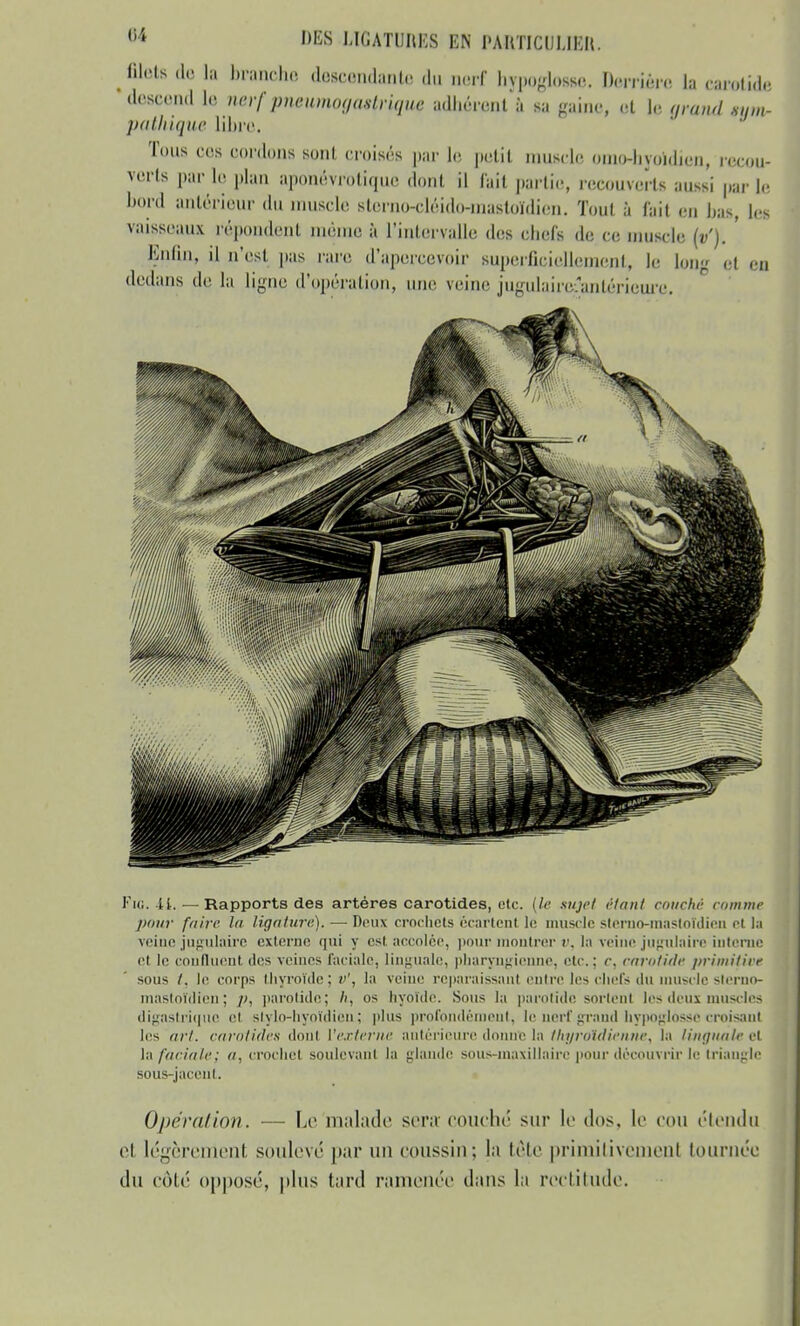 filets de la branche descendante du nerf hypoglosse. Derrière la cacotidi •descend le nerf pneumoqastriqiie adhérent 6 sa gaine, et le grand xiiin- pathique libre. Tous ces cordons sont croisés par le petit musde omo-livoidicn, recou- verts par le plan aponévrotique dont il fait partie, recouverts aussi par le bord antérieur du muscle sterno-cléido-maitoïdien. Tout à fait en bas, les vaisseaux répondent même à l'intervalle des chefs de ce muscle (v). ' Enfin, il n'est pas rare d'apercevoir superficiellement, le long et en dedans de la ligue d'opération, une veine jugulaire£antéricure. FiO. 41. — Rapports des artères carotides, etc. (le sujet (-tant couché comme pour faire la ligature). — Deux crochets écartent le muscle slerno-mastoïdicn et la veine jugulaire externe qui y est accolée, pour montrer r. la veine jugulaire interne et le confluent des veines faciale, linguale, pharyngienne, etc.; c. carotide primitire sous /. le corps thyroïde; v', la veine reparaissant entre les chefs du musclesterno- masloïdien ; p, parotide; h, os hyoïde. Sous la parotide sortent les deux muscles digastrique et stylo-hyoïdien; plus profondément, le nerf grand hypoglosse croisant les art. carotides donl ['externe autéricure donne la thyroïdienne, la linguale et \;\ faciale; a, crochet soulevant la glande sous-maxillaire pour découvrir le triangle sous-jacent. Opération. — Le malade sera couché sur le tins, le cou étendu et légèrenlent soulevé par un coussin; la tète primitivement lotiniée du côté opposé, plus tard ramenée dans la rectitude.