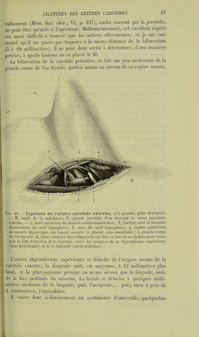 ralliement [Mém. Soc dur., VI, p. 197), caché souvent par la parotide ,„, peui être qu'utile à L'opérateur. Malheureusement, cet excellent repère est aussi difficile à trouver que les artères elles-mêmes, et je me suis assuré qu'il ne passe pas toujours à La même distance de la bifurcation (,') à 20 millimètres). Il ne peul donc servir à déterminer, d'une manière précise, à quelle hauteur on va placer le fil. La bifurcation de la carotide primitive se fait un peu au-dessous de là m-ande corne de l'os hvoïde, parfois même au niveau de ce repère osseux. Fie. l.'i. — Ligature de l'artère carotide externe, colé gaucho, pluie disséquée. — M, angle de la mâchoire ; P, glande parotide d'où descend la veine jugulaire externe. — 1, hord antérieur du muscle sterne-mastoïdien ; 2, l'artère avec ia branche descendante du nerf hypoglosse: 5, anse du nerf hypoglosse; -i, ventre postérieur du muscle digastrique sur lequel empiète la glande sous-maxillaire ; o, grande corne de l'os hyoïde; 6, tronc veineux Ihyro-lingno-faeial tiré en bas et en dedans pour mon- trer le lien d'élection de la ligature, entre les origines de la thyroïdienne supérieure (sous-hyoïdienne) et de la linguale (sus-hyoïdienne). L'artère thxjroïdienr^e supérieure se détache de l'origine même de la carotide externe; la linguale naît, en moyenne, à 12 millimètres plus haut, cl la pharyngienne presque au même niveau que la Linguale, mais de la l'ace profonde du vaisseau. La faciale se détache à quelques milli- mètres au-dessus de la linguale, puis l'occipitale,... puis, mais après do 2 centimètres, l'auriculaire. Il existe donc ordinairement un centimètre d'intervalle, quelquefois