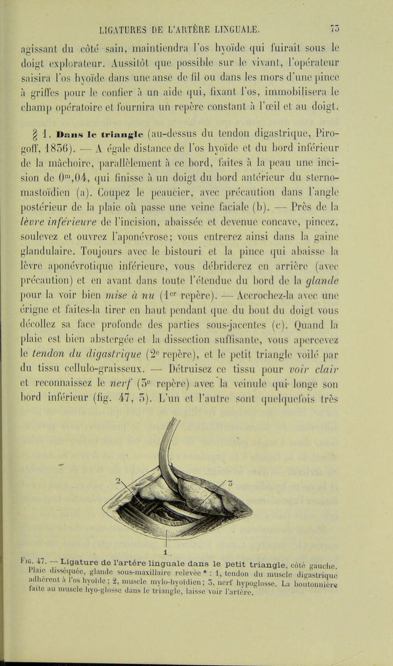 agissant du côté sain, maintiendra l'os hyoïde (|iii fuirait sous le doigt explorateur. Aussitôt que possible sur le vivant, l'opérateur saisira l'os Inouïe dans une anse de lil ou dans les mors d'une pince à grilles pour le confier à un aide qui, fixant l'os, immobilisera le champ opératoire et fournira un repère constant à l'œil et au doigt. g 1. Dans le triangle (au-dessus du tendon digastrique, Piro- goff, 1856). •— À égale distance de l'os hyoïde et du bord inférieur de la mâchoire, parallèlement à ce bord, laites à la peau une inci- sion de 0m,04, qui finisse à un doigt du bord antérieur du sterno- mastoïdien (a). Coupez le peaucier, avec précaution dans l'angle postérieur de la plaie où passe une veine faciale (b). — Près de la lèvre inférieure de l'incision, abaissée et devenue concave, pincez, soulevez et ouvrez l'aponévrose; vous entrerez ainsi dans la gaine glandulaire. Toujours avec le bistouri et la pince qui abaisse la lèvre aponévrotique inférieure, vous débriderez en arrière (avec précaution) et en avant dans toute l'étendue du bord de la glande pour la voir bien mise à nu (1er repère). — Accrochez-la avec mu' érigne et faites-la tirer en haut pendant que du bout du doigt vous décollez sa face profonde des parties sous-jacentes (c). Quand la plaie est bien abstergée cl la dissection suffisante, vous apercevez le tendon du digastrique (2° repère), et le petit triangle voilé par du tissu cellulo-graisseux. — Détruisez ce tissu pour voir clair et reconnaissez le nerf (3e repère) avec la veinule qui- longe son bord inférieur (fig. 47, 5). L'un et l'autre sont quelquefois très ni47' 7 Ligature de l'artére linguale dans le petit triangle, côté gauche Haie disséquée, glande sous-maxillaire relevée*: 1, tendon du muscle digastriqu< adhérent al os hyoïde; 2, muscle mylo-l.yoïdicn; 3, nerf hypoglosse. La houtonnien laite au muscle hyo-ylosse dans le triangle, laisse voir l'artère.