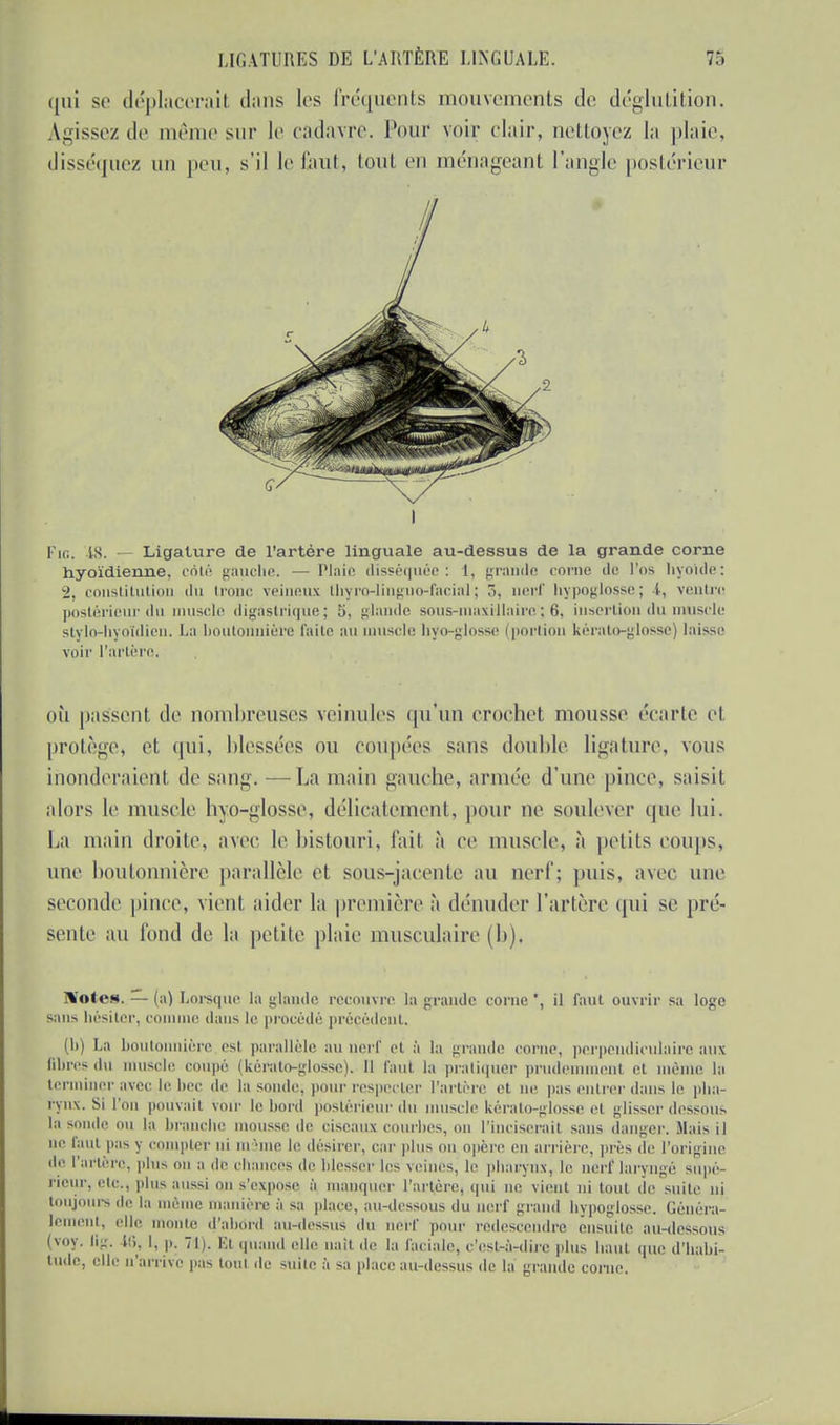 qui se déplacerai! dans les fréquents mouvements de déglutition. Agissez de même sur le cadavre. Pour voir clair, nettoyez la plaie, disséquez un peu, s'il le faut, toul en ménageant l'angle postérieur i Fie. 18. Ligature de l'artère linguale au-dessus de la grande corne hyoïdienne, côté gauche. — Plaie disséquée: 1, grondé corne de l'os hyoïde: 2, constitution du tr i veineux thyroJinguo-facial; 3, nerf hypoglosse; i. ventre postérieur du muscle digastrique; 5, glande sous-maxillaire; 6, insertion du muscle stylo-hyoïdien. La boutonnière l'aile au muscle hyo-glosse (portion kérato-glosse) laisse voir l'artère, où passent de nombreuses veinules qu'un crochet mousse écarte el protège, et qui, blessées ou coupées sans double ligature, vous inonderaient de sang. —La main gauche, armée d'une pince, saisit alors le muscle hyo-glosse, délicatement, pour ne soulever que lui. Lu main droite, avec le bistouri, l'ail à ce muselé, à petits coups, une boutonnière parallèle et sous-jacente au nerf; puis, avec une seconde pince, vient aider la première à dénuder l'artère qui se pré- sente au fond de la petite plaie musculaire (h). 3%'otc». — (a) Lorsque la glande recouvre la grande corne *, il faut ouvrir sa loge sans hésiter, connue dans le procédé précédent. (b) La boutonnière est parallèle au nerf et à la grande corne, perpendiculaire aux libres du muscle coupé (kérato-glosse). Il faut la pratiquer prudemment et même la terminer avec le bec de la sonde, pour respecter l'artère et ne pas entrer dans le pha- rynx. Si l'on pouvait voir le bord postérieur du muscle kérato-glosse el glisser dessous la sonde ou la branche mousse de ciseaux courbes, on l'inciserait sans danger. Mais il ne faut pas y compter ni même le désirer, car plus on opère en arrière, près de l'origine de l'artère, plus on a de chances do blesser les veines, le pharynx, le nerf laryngé supé- rieur, etc., plus aussi on s'expose à manquer l'artère, qui ne vient ni tout de suite ni toujours île la même manière à sa place, au-dessous du nerf grand hypoglosse. Généra- lement, elle monte d'abord au-dessus du nerf pour redescendre ensuite au-dessous (voy. Ilg. 46, 1, p. 71). Et quand elle naît de la faciale, c'est-à-dire plus haut que d'habi- tude, elle n'arrive pas tout de suite à sa place au-dessus de la grande coine.