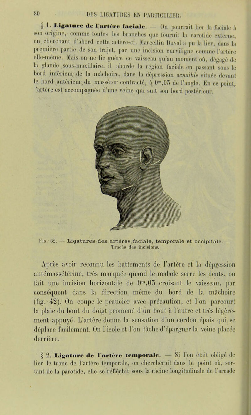 § l llfature de 1,'artore faciale. On pourrait lier la faciale a son origine, comme toutes les branches que fournil la carotide externe, on cherchant d'abord cette artère-ci. Marcellin Duval p pu la lier, dans la première partie de son trajet, par une incision curviligne comme l'artère elle-même. Mais on ne lie guère ce vaisseau qu'au moment où, dégagé de la glande sous-maxillaire, il aborde la région l'aeiale en passant sous le boni inférieur, de la mâchoire, dans la dépression sensible située devant le boni antérieur, du inassoler contracté, à ()m,0.7) de l'angle. En ce point, 'artère est accompagnée d'une veine qui suit son boni postérieur. l'iu.' U2. — Ligatures des artères faciale, temporale et occipitale. — Tracés des incisions. Après avoir reconnu les battements de l'artère cl la dépression antémassétérine, très marquée quand le malade serre les dents, on l'ait une incision horizontale de 0m,0T> croisant le vaisseau, par conséquent dans la direction même du bord de la mâchoire (fig. 42). On coupe le peaucier avec précaution, et l'on parcourt la plaie du bout du doigt promené d'un bout à l'autre et très légère- ment appuyé. L'artère donne la sensation d'un cordon épais qui se déplace facilement. On l'isole et l'on tâche d'épargner la veine placée derrière. § 2. Ligature de l'artère temporale. - - Si l'on était obligé de lier le tronc de l'artère,temporale, on chercherait dans le point où, sor- tant de la parotide, elle se réfléchit sous la racine longitudinale de l'arcade