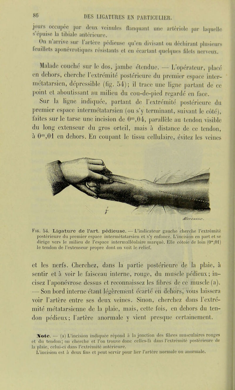 jours occupée par deux veinules flanquanl une artériole par laquelle s'épuise la tibiale antérieure. On n'arrive sur l'artère pédieusQ qu'en divisant ou déchirant plusieurs feuillets aponévrotiques résistants et un «Variant quelques filet* nerveux. Malade couché sur le dos, jambe étendue. — L'opérateur, placé en dehors, cherche l'extrémité postérieure du premier espace inter- métatarsieni dépressible (fig. 54); il trace une ligne partant de ce point cl aboutissant au milieu du cou-de-pied regardé en face. Sur la ligné indiquée, partant de l'extrémité postérieure du premier espace intermétatarsien (ou s'y terminant, suivant le côté), laites sur le tarse une incision de 0m,04, parallèle au tendon visible du long extenseur du gros orteil, mais à distance de ce tendon, à 0m,01 en dehors. En coupant le tissu cellulaire, évitez les reines CS/S S* ~ . Fig. 5i. Ligature de l'art, pédieuse. — L'indicateur gauche cherche l'extrémité postérieure du premier esp;ice intermêtalarsien et s'y enfonce. L'incision en part et se dirige vers le milieu de l'espace intermalléolaire marqué. Elle côtoie de loin (0.01) le tendon de l'extenseur propre dont on voit le relief. et les nerfs. Cherchez, dans la partie postérieure de la plaie, à sentir et à voirie faisceau interne, rouge, du muscle pédieux; in- cisez l'aponévrose dessus et reconnaissez les libres de cé muscle (a i. — Son bord interne étant légèrement écarté en dehors, vous laissera voir l'artère entre ses deux veines. Sinon, cherchez dans l'extré- mité métatarsienne de la plaie, mais, celte fois, en dehors du ten- don pédieux; l'artère anormale y vient presque certainement. IWote. — (a) L'incision indiquée répond :i 1m jonction des fihrcs musculaires rouges et du tendon; on cherche et l'on trouve donc celles-là dans l'extrémité postérieure «le la plaie, celui-ci dans l'extrémité antérieure. L'incision est à deux lins cl peut servir pour lier l'artère normale ou anormale.