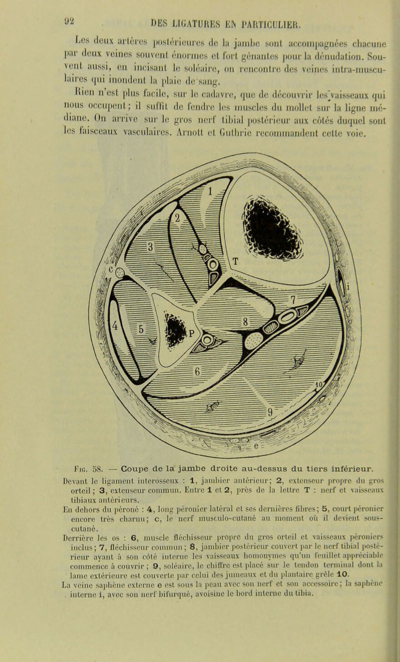 Les doux artères postérieures de la jambe sont accompagnées chacune par ileux veines souvenl énormes et fort gênantes pour la dénudalion. Sou- vent aussi, en incisant le soléaire, on rencontre des veines intra-nniscu- laires qui inondent la plaie de sang. Rien n'est plus facile, sur le cadavre, que de découvrir lcs]vaisscaux qui nous occupent; il suffit de fendre les muscles du mollet sur la ligne mé- diane. On arrive sur le gros nerf lihial postérieur aux cotés duquel sont les faisceaux vasculaires. Arnott et Guthrie recommandent cette voie. Fig. 58. — Coupe de la jambe droite au-dessus du tiers inférieur. Devant le ligament interosseux : 1, jambier antérieur; 2, extenseur propre du gros orteil ; 3, extenseur commun. Entre 1 et 2, près de la lettre T : nerf cl vaisseaux tibiaux antérieurs. En dehors du péroné : 4, long péronier latéral et ses dernières fibres; 5, court péronier encore très charnu; c, le nerf musculo-cutané au moment où il devient sous- cutané. Derrière les os : 6, muscle fléchisseur propre du gros orteil et vaisseaux péronier* inclus; 7, fléchisseur commun ; 8, jambier postérieur couvert par le nerf tibia] posté- rieur ayant à son côté interne les vaisseaux homonymes qu'un feuillet appréciable commence ù couvrir ; 9, soléairc, le chiffre est placé sur le tendon terminal dont la lame extérieure est couverte par celui des jumeaux et du plantaire grêle 10. La veine saphène externe e est sous la peau avec son nerf et son accessoire ; la saphënc interne i, avec sou nerf bifurqué, avoisine le bord interne du tibia.