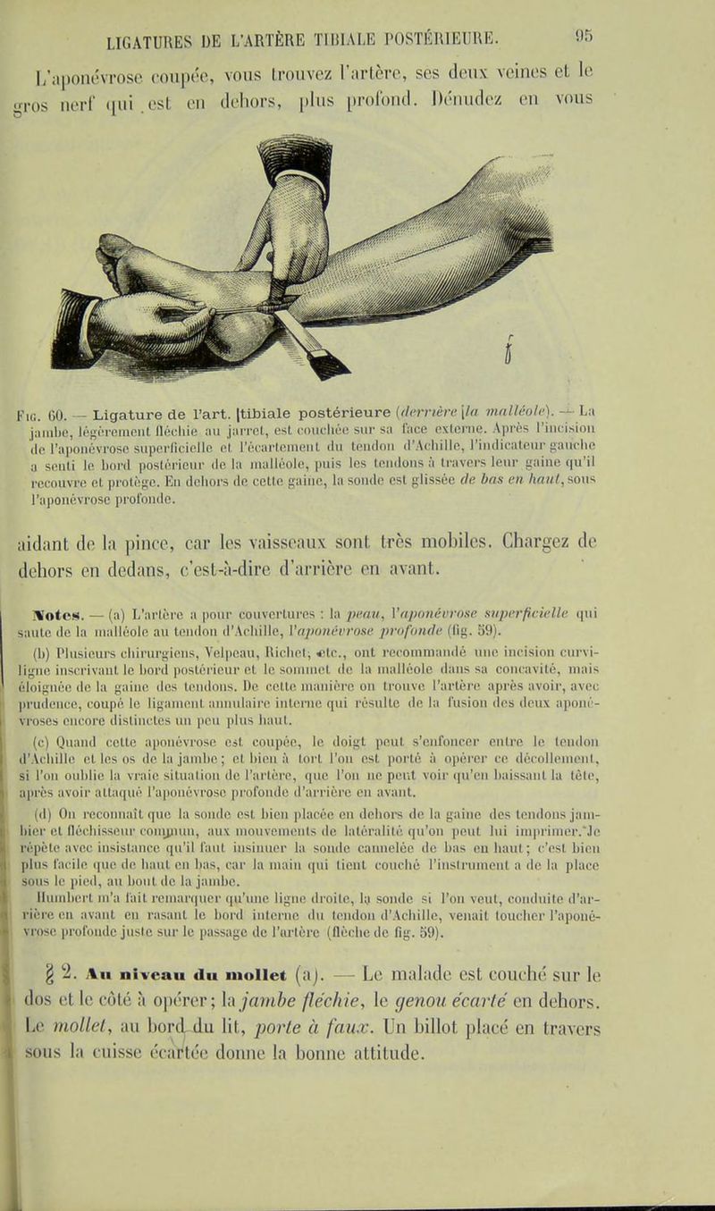 Fie. 60. - Ligature de l'art. Jtibiale postérieure {derrière [la malléole). 4. La jambe, légèrement fléchie au jarret, est couchée sur sa l'ace externe. Après l'incision del'aj jyrose superficielle e! l'écarte rit du tendon d'Achille, l'indicateur gauche a senti le bord postérieur de la malléole, puis les tendons à travers leur gaine qu'il recouvre et protège. En dehors de cette gaine, la sonde est glissée île bas en haut, sous l'aponévrose profonde. aidant de la pince, car les vaisseaux sont très mobiles. Chargez de dehors en dedans, c'est-à-dire d'arrière en avant. i¥otcs. — (a) L'artère a pour couvertures : là peau, ['aponévrose superficielle qui iaute de la malléole au tendon d'Achille, {'aponévrose profonde (fig. 5!)). (Ii) Plusieurs chirurgiens, Velpeau, Richet; etc., ont recommandé une incision curvi- ligne inscrivant le bord postérieur el le sommet de la malléole dans sa concavité, mais éloignée de la gaine des tendons. De cette manière on trouve l'artère après avoir, avec prudence, coupé le ligament annulaire interne qui résulte de la fusion des deux aponé- vroses encore distinctes un peu plus haut. (c) Quand cette aponévrose est coupée, le doigt peul s'enfoncer entre le tendon d'Achille ci les os de la jambe; el bien à tort l'un esl porté à opérer ce décollement, si l'on oublie la vraie situation de l'artère, qui' l'on ne peul voir qu'eu baissant la tête, après avoir attaqué l'aponévrose profonde d'arrière en avant. (d) Ou reconnaît que la sonde est bien placée en dehors de la gaine des tendons jam- bier et fléchisseur conynun, aux mouvements de latéralité'qu'on peut lui imprimer.'Je répète avec insistance qu'il faut insinuer la sonde cannelée de bas eu haul : c'est bien plus facile que de haut en bas, rai- la main qui tient couché l'instrument a de la place sous le pied, au bout de la jambe. Humbert m'a lait remarquer qu'une ligne droite, la sonde si l'on veut, conduite d'ar- rière m avant en rasant le bord interne du tendon d'Achille, venait toucher l'aponé- vrose profonde juste sur le passage de l'artère (flèche de 11g. 59). £ 2. \n niveau du mollet (a). - Le malade est couche sur le dos et le côté à opérer; la jambe fléchie, le genou écarté en dehors. I.e mollet, au bord du lit, porte à faux. In billot placé eu travers sous la cuisse écartée donne la lionne attitude.