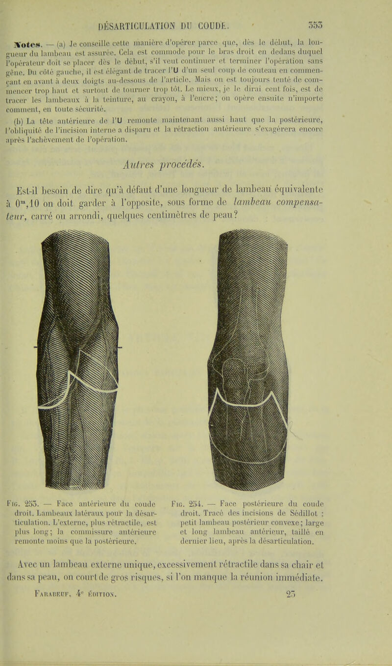 Xotes. — (a) Je conseille cette manière d'opérer parce que, des le début, la lon- gueur du lambeau est assurée. Cela esl commode pour le. bras droit en dedans duquel l'opérateur doil se placer dés le débul, s'il veut continuer et terminer l'opération sans Irène. Du côté gauche, il esl éléganl de tracer l'U d'un seul coup dé couteau en commen- „ani ,,„ uvanl ii deux doigts au-dessous de l'article. .Mai* on esl toujours tenté de com- mencer trop liant et surtout de tourner trop lot. Le mieux, je le dirai cent fois, est de tracer les lambeaux à la teinture, au crayon, à l'encre; on opère ensuite n'importe comment, en toute sécurité. (b) l.a tête antérieure de l'U remonte maintenant aussi baut que la postérieure, l'obliquité de l'incision interne a disparu et la rétraction antérieure s'exagérera encore après l'achèvement de l'opération. Autres procédés. Est-il besoin de dite qu'à défaut d'une longueur de lambeau équivalente à 0m,10 on doit garder à l'opposite, sous forme de lambeau compensa- teur, carré ou arrondi, quelques centimètres de peau? Fig. 253. — Face antérieure du coude droit. Lambeaux latéraux pour la désar- ticulation. L'externe, plus rétractile, est plus long; la commissure antérieure remonte moins que la postérieure. Fie 254. — Face postérieure du coude droit. Tracé des incisions de Sédillot : petit lambeau postérieur convexe; large et long lambeau antérieur, taillé en dernier lieu, après la désarticulation. Avec un lambeau externe unique, excessivement rélraclile dans sa chair et dans sa peau, on court de gros risques, si l'on manque la réunion immédiate. Pakabeof, 4 ÉDITION. 27)