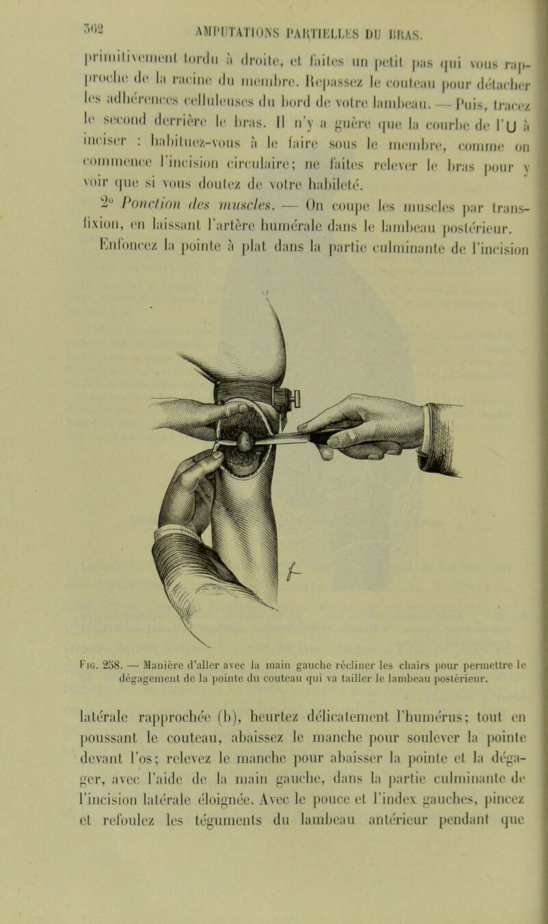 primitivement tord» à droite, et faites on petil pas <|ui vous ranJ proche de la paoine «lu membre. Repassez le eouteau pour détaches les adhérences eelluleuses du bord de votre lambeau.- Puis, tracez le second derrière le bras. Il n'y a guère que la courbe de l'u 1 inciser : nabituea-rçous a le faire sous Je membre, comme on commence l'incision circulaire; ne faites relever le bras pour gj voir que si vous douiez de voire habileté. Ponction des muscles. — On coupe les muscles par trans- Qxion, eu laissant l'artère humérale <l ans le lambeau postérieur. Enfoncez la pointe à plat dans la partie culminante de l'incision Fie 258. — Manière d'aller avec Ja main gauche récliner les chairs pour permettre le dégagement de la pointe du couteau qui va tailler le lambeau postérieur. latérale rapprochée (1)), heurtez délicatement l'humérus; tout en poussant le couteau, abaissez le manche pour soulever la pointe devant l'os; relevez le manche pour abaisser la poinle el la déga- ger, avec l'aide de la main gauche, dans la partie culminante de l'incision latérale éloignée. Avec le pouce cl l'index guiches, pincez et relouiez les téguments du lambeau antérieur pendant que