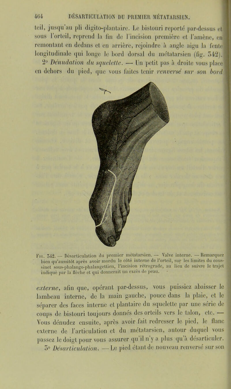 teil, jus(|u'au pli digito-plantàire. Le bistouri reporté pardessus el sous L'orteil, reprend la fin de l'incision première et l'amène, en remontant en dedans et en arrière, rejoindre à angle aigu la fente longitudinale qui longe le bord dorsal du métatarsien (fig. 542)1 2° Dénudai ion du squelette. — Un petit pas à droite vous placé en dehors du pied, <jue vous faites tenir renversé sur son bord Fin. 542. — Désarticulation du premier métatarsien. — Valve interne. — Remarquez bien qu'aussitôt après avoir mordu le côté interne de l'orteil, sur les limites du cous- sinet sous-plialaiigo-phalangcltien, l'incision rétrograde, au lieu de suivre le trajet indiqué par la llèclic et qui donnerait un excès de peau. • externe, afin que, opérant par-dessus, vous puissiez abaisser le lambeau interne, de la main gauche, pouce dans la plaie, et le séparer des faces interne et plantaire du squelette par une série de coups de bistouri toujours donnés des orteils vers le talon, etc. — Vous dénudez ensuite, après avoir fait redresser le pied, le flanc externe de l'articulation et du métatarsien, autour duquel vous passez le doigt pour vous assurer qu'il n'y a plus qu'à désarticuler. 3° Désarticulation^ —Le pied étant de nouveau renversé SUT SOI)