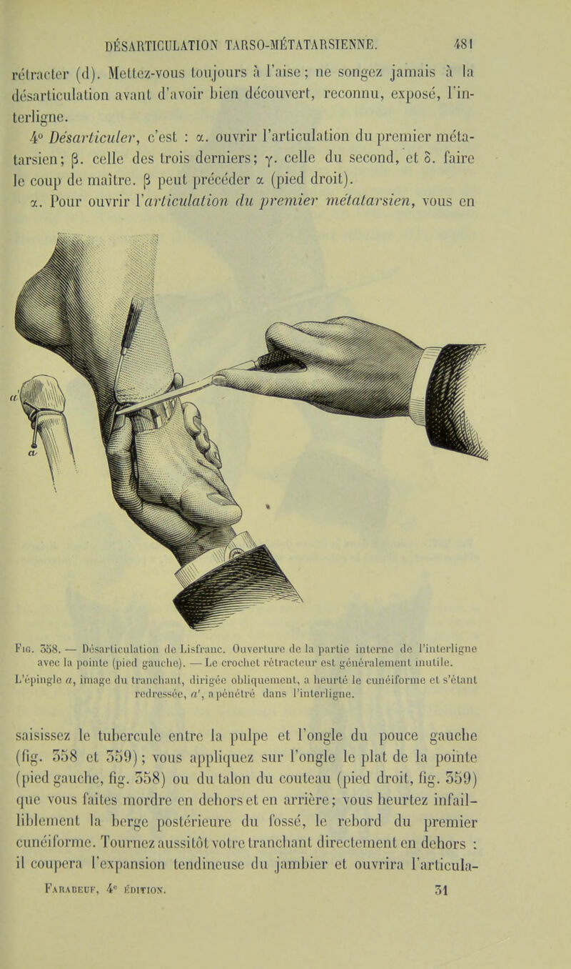 rétracter (d). Mettez-vous toujours à l'aise; ne songez jamais à la désarticulation avant d'avoir bien découvert, reconnu, exposé, l'in- terligne. iu Désarticuler, c'est : a. ouvrir l'articulation du premier méta- tarsien; [3. celle des trois derniers; y. celle du second, et o. faire le coup de maître. |3 peut précéder a (pied droit). a. Pour ouvrir Y articulation du premier métatarsien, vous en Fig. 3o8. — Désarticulation de Lisl'ranc. Ouverture de la partie interne de l'interligne avec la pointe (pied gauche). —Le crochet, rétracteur est généralement mutile. L'épingle a, image du tranchant, dirigée obliquement, a heurté le cunéiforme et s'ètant redressée, a', a pénétré dans l'interligne. saisissez le tubercule entre la pulpe et l'ongle du pouce gauche (fig. 558 et 359); vous appliquez sur l'ongle le plat de la pointe (pied gauche, fig. 358) ou du talon du couteau (pied droit, fig. 559) que miiis faites mordre en dehorsel en arrière; vous heurtez infail- liblement la berge postérieure du fossé, le rebord du premier cunéiforme. Tournez aussitôt votre tranchant directement en dehors : il coupera l'expansion tendineuse du jambier et ouvrira l'articula- Fakadeuk, 4° édwiok. 51