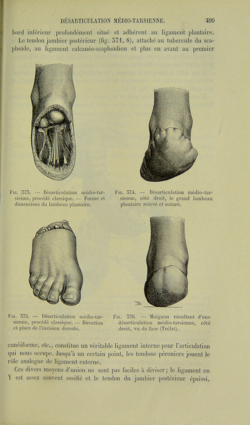 bord inférieur profondément situé et adhérent au ligament plantaire. Le tendon jambier postérieur (fig. 571, 8), attaché au tubercule du sca- phoïde, au ligament calcanéo-scaphoïdien et plus en avant au premier fie. 373. — Désarticulation niédio-tar- Fig. 37-1. — Désarticulation médio-tar- sienne, procédé classique. — Forme cl sienne, côté droit, le grand lambeau dimensions du lambeau plantaire. plantaire relevé el suturé. Fig. 375. — Désarticulation médio-tar- sienne, procédé classique. — Direction et place de l'incision dorsale. Fig. 37G. — Moignon résultant d'une désarticulation médio-tarsienne, côté droit, vu de face (Trélat). cunéiforme, etc., constitue un véritable ligament interne pour l'articulation qui nous occupe. Juscra'à un certain point, les tendons pér-oniers jouent le rôle analogue de ligament externe. Ces divers moyens d'union ne sont, pas faciles à diviser; le ligament en est assez souvent ossifié et le tendon du jambier postérieur épaissi,