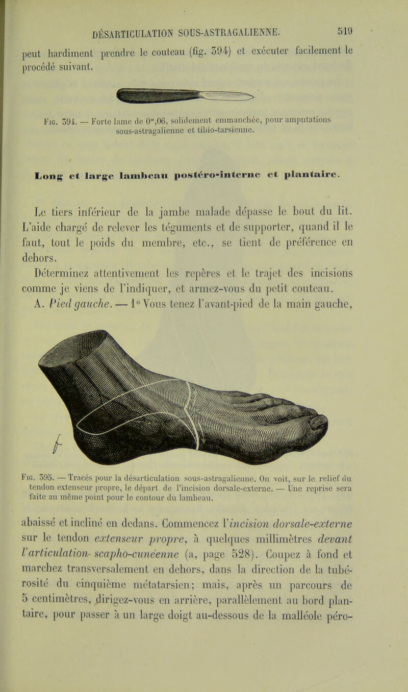 peut hardiment prendre le couteau (fig. 394) et exécuter facilement le procédé suivant. Fig. 591. — Forlc lame de 0,n,06, solidement emmanchée, pour amputations sous-astragalicnne et tibio-tarsienne. Long et large lambeau postéro-interne et plantaire. Le tiers inférieur de la jambe malade dépasse le bout du lit. L'aide chargé de relever les téguments et de supporter, quand il le faut, tout le poids du membre, etc., se tient de préférence en dehors. Déterminez attentivement les repères et le trajet des incisions comme je viens de l'indiquer, et armez-vous du petit couteau. A. Pied gauche. — l°Vous tenez l'avant-pied de la main gauche, Fig. r>!)5. — Tracés pour la désarticulation sous-astragalienne. On voit, sur le relief du tendon extenseur propre, le départ de l'incision dorsale-externe. — Une reprise sera faite au même point pour le contour du lambeau. abaissé et incliné en dedans. Commencez Y incision dorsale-externe sur le tendon extenseur propre, à quelques millimètres devant Varticulation scapho-cunéenne (a, page 528). Coupez à fond et man iiez transversalement en dehors, dans la direction de la tubé- rosité du cinquième métatarsien; mais, après un parcours de 5 centimètres, dirigez-vous en arrière, parallèlemonl au bord plan- taire, pour passer à un large doigt au-dessous de la malléole péro-