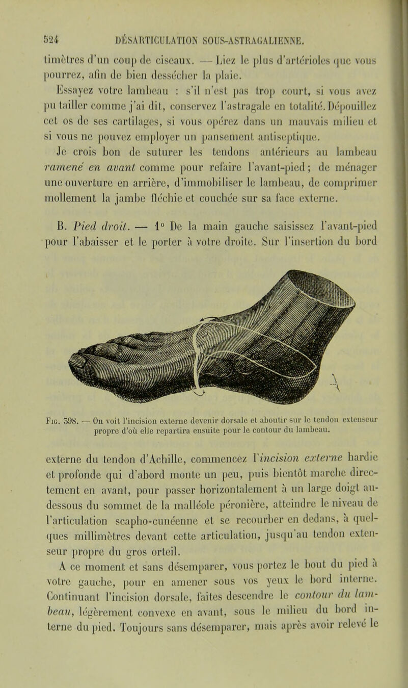 timètres d'un coup de ciseaux. - liiez le plus d'arlérioles que vous pourrez, afin de bien dessécher la plaie. Essayez voire lambeau : s'il n'est pas trop court, si vous avez pu tailler comme j'ai dit, conservez L'astragale en totalité. Dépouillez cet os de ses cartilages, si vous opérez dans un mauvais milieu et si vous ne pouvez employer lin pansement antiseptique. Je crois bon de suturer les tendons antérieurs au lambeau ramené en avant comme pour refaire l'avanl-pied; de ménager une ouverture en arrière, d'immobiliser le lambeau, de comprimer mollement la jambe llécbie et couchée sur sa face externe. B. Pied droit. — 1° De la main gauche saisissez l avant-pied pour l'abaisser et le porter à votre droite. Sur l'insertion du bord Fie. 398. — On voit l'incision externe devenir dorsale et aboutir sur le tendon extenseur propre d'où elle repartira ensuite pour le contour du lambeau. externe du tendon d'Achille, commencez Yincision externe hardie et profonde qui d'abord monte un peu, puis bientôt marche direc- tement en avant, pour passer horizontalement à un large doigt au- dessous du sommet de la malléole péronière, atteindre le niveau de l'articulation scapho-cunéenne et se recourber en dedans, à quel- ques millimètres devant celle articulation, jusqu'au tendon exten- seur propre du gros orteil. A ce moment et sans désemparer, vous portez le bout du pied à votre gauche, pour en amener sous vos yeux le bord interne. Continuant l'incision dorsale, faites descendre le contour du lam- beau, légèrement convexe en avant, sous le milieu du bord in- terne du pied. Toujours sans désemparer, mais après avoir relevé le