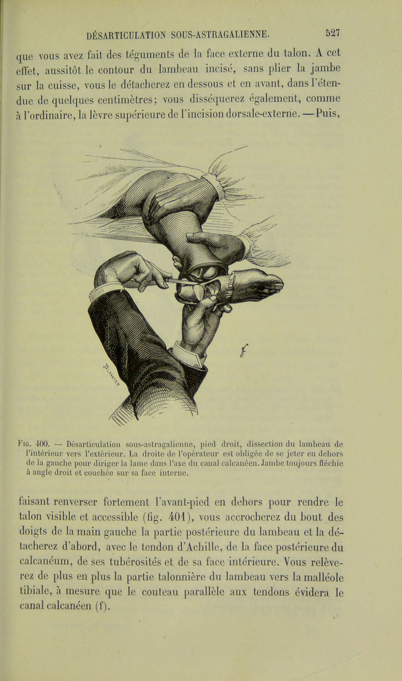 que vous avez fait des téguments de la face externe du talon. A cet effet, aussitôt le contour du lambeau incisé, sans plier la jambe sur la cuisse, vous le détacherez en dessous et en avant, dans l'éten- due de quelques centimètres; vous disséquerez également, comme à l'ordinaire, la lèvre supérieure de l'incision dorsale-externe. —Puis, Fie. 400. — Désarticulation sous-astragalienne, pied droit, dissection du lambeau de. l'intérieur vers l'extérieur. La droite de l'opérateur est obligée de se jeter en dehors de la gauche pour diriger la laine dans l'axe du canal calcanéen. Jambe toujours fléchie à angle droit et couchée sur sa face interne. faisant renverser fortement l'avant-pied en dehors pour rendre le talon visible et accessible (lig. 401), vous accrocherez du bout des doigts de la main gauche la partie postérieure du lambeau et la dé- tacherez d'abord, avec le tendon d'Achille, de la face postérieure du calcanéum, de ses tubérosités et de sa face intérieure. Vous relève- rez de plus en plus la partie talonnière du lambeau vers la malléole tibiale, a mesure que le couteau parallèle aux tendons évidera le canal calcanéen (f).