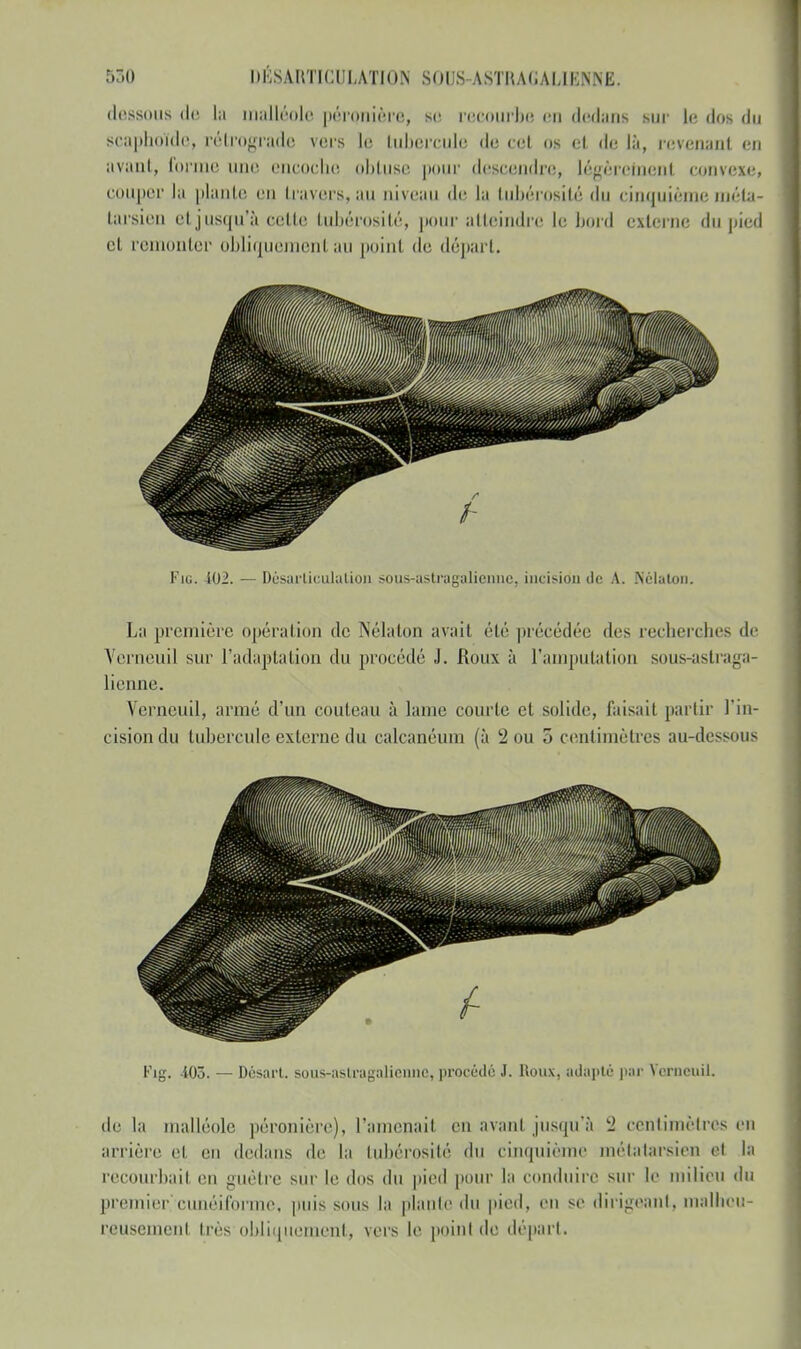 dessous de la malléole péronière, se recourbe en dedans but le dos du scapboïde, rétrograde vers le tubercule de cet os et de là, revenant en avant, forme une. encoche obtuse pour descendre, légèrement convexe» couper la piaule, en L'avers, au niveau de la tubérosité du cinnuièmeméta- tarsien cl jusqu'à celle tubérosité, pour atteindre le bord externe du |>icd cl remonter obliquemenl au poinl de départ. Fiu. 402. — Désarticulation sous-astragalienne, incisiou de A. Nélaton. La première opération de Nélaton avait été précédée des recherches de Verneuil sur l'adaptation du procédé J. Roux à l'amputation sous-astraga- lienne. Verneuil, armé d'un couteau à laine courte et solide, faisait partir l'in- cision du tubercule externe du calcancum (à 2 ou 5 centimètres au-dessous Fig. 405. — Désart. sous-astragalienne, procédé J. Houx, adapté par Vcrnouil. de la malléole péronière), l'amenait en avant jusqu'à 2 centimètres en arrière et en dedans de la tubérosité du cinquième métatarsien cl la recourbait en guêtre sur le dos du pied pour la conduire sur le milieu du premier/cunéiforme* puis sous la piaule du pied, en se dirigeant, malhibu- reuseinent très-obliquement-, vers le point de départ.