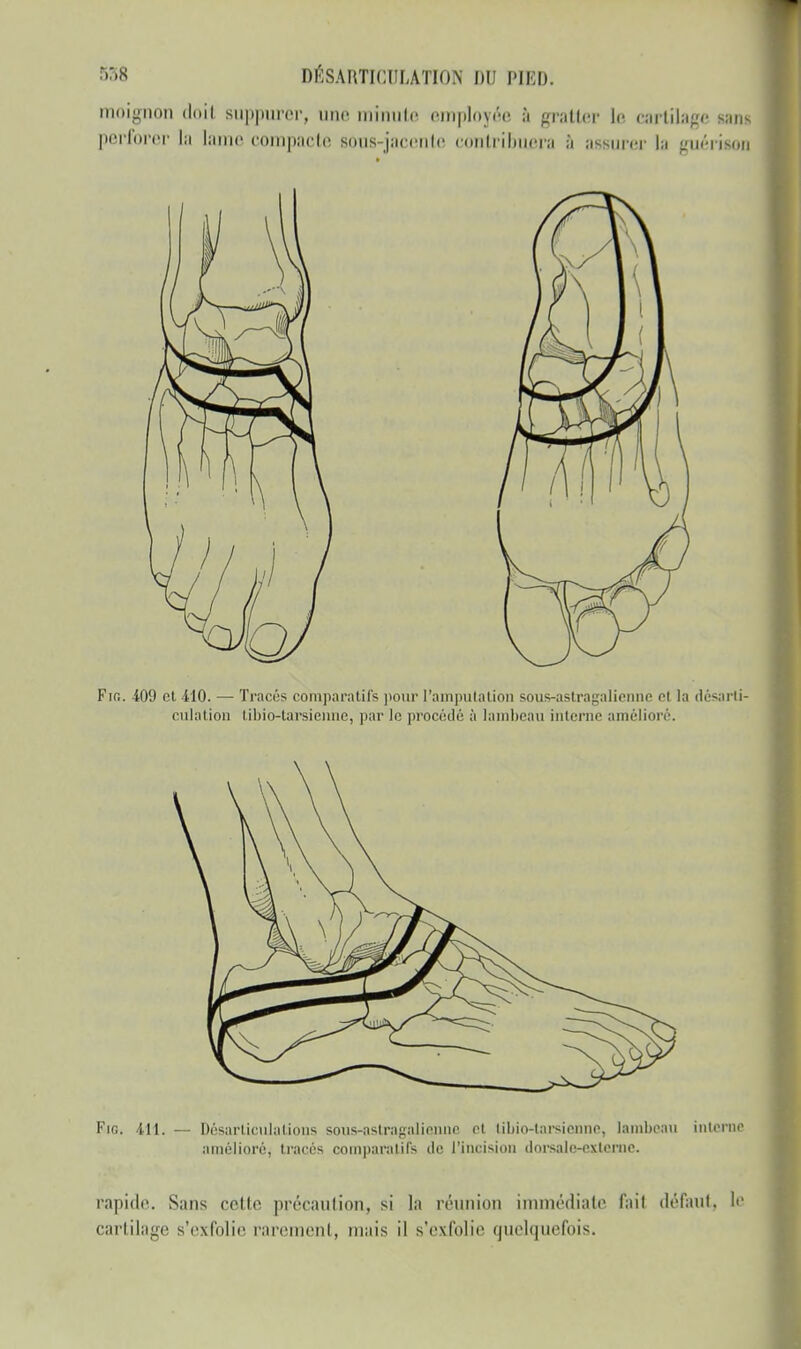 moignon doil suppurer, une minute employée à gratter le cartilage tau perforer la lame compacte sôus-jacente contribuera à assurer la guériaon Fio. 409 et 410. — Tracés comparatifs pour l'amputation sous-astragalienne et la désarti- culation liliio-larsiciinc, par le procédé à lambeau interne amélioré. Fie. 411. — Désarticulations soias-astragalienne et tibio-tarsienne, lambeau interna amélioré, tracés comparatifs do l'incision dorsale-externe. rapide. Sans cette précaution, si la réunion immédiate fait défaut, le cartilage s'exfolie rarement, mais il s'exfolie quelquefois.