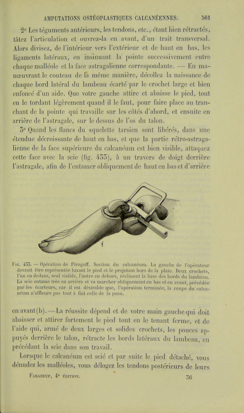 2° Les téguments antérieurs, les tendons, etc., étant bien rétractés, tàtez l'articulation et ouvrez-la en avant, d'un trait transversal. Alors divisez, de l'intérieur vers l'extérieur et de haut en bas, les ligaments latéraux, en insinuant la pointe successivement entre chaque malléole cl la face astragalienne correspondante. — En ma- nœuvrant le couteau delà même manière, décollez la naissance de chaque bord latéral du lambeau (Varié par le crochet large et bien enfoncé d'un aide. Que votre gauche attire et abaisse le pied, tout en le tordant légèrement quand il le faut, pour faire place au tran- chant de la pointe qui travaille sur les côtés d'abord, et ensuite en arrière de l'astragale, sur le dessus de l'os du talon. 5° Quand les lianes du squelette tarsien sont libérés, dans une étendue décroissante de haut en bas, et que la partie rétro-astraga- lienne de la face supérieure du calcanéum es! bien visible, attaquez cette face avec la scie (fig. 455), à un travers de doigt derrière l'astragale, afin de l'entamer obliquement de hauten bas et d'arrière Fig. 433. — Opération de Pirogofl. Section du calcanéum. La gauche de l'opérateur devrait être représentée luxant le pied et le projetant hors de la plaie. Deux croehels. l'un en dedans, seul visible, l'autre en dehors, réclinent la hase des bords du lambeau. La scie entame très en arrière el va marcher obliqu enl en bas el en avant, précédée parles écarteurs, car il est désirable que, l'opération terminée, la coupe du calca- néum n'affleure pas tout à l'ait celle de la peau. enavant(b).—La réussite dépend et de voire main gauche qui doit abaisser et attirer fortement le pied tout en le tenant ferme, el de l'aide qui, armé de deux larges et solides crochets, les pouces ap- puyés derrière le talon, rétracte les bords latéraux du lambeau, en précédant la scie dans son travail. Lorsque le caleanéum est scié et par suite le pied détaché, vous dénudez les malléoles, vous délogez les tendons postérieurs de leurs Faîudeuf, 4° ÉDITION. 3g