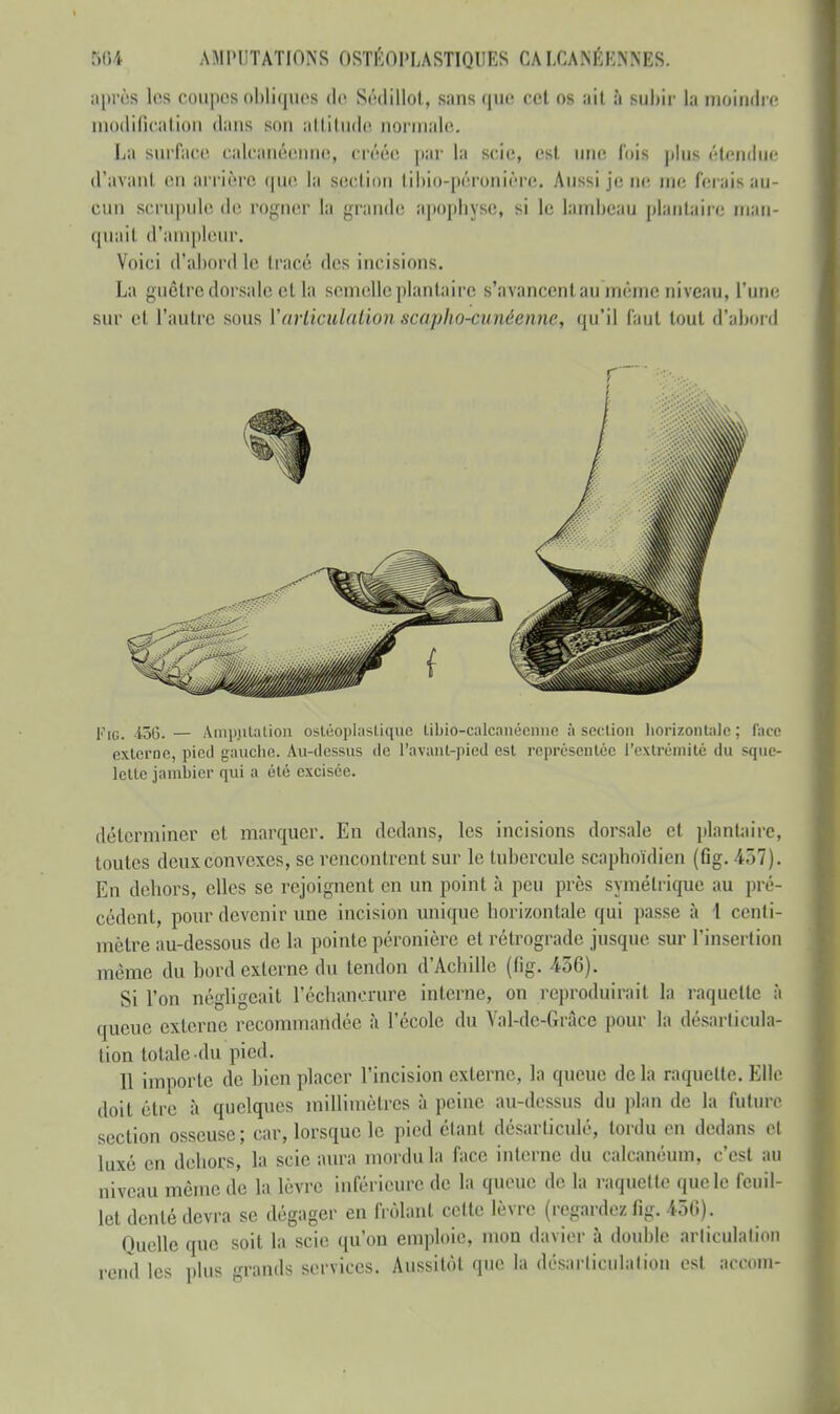 après les coupes obliques do Sédillot, sans que cet os ait à subir la moindre modification (Luis son attitude normale. La surface calcanéenne, créée par la scie, est une fois plus étendue d'avant en arrière que la section tibio-péronière» Aussi je ne. me ferais au- cun scrupule de rogner la grande apophyse, si le lambeau plantaire man- quait d'ampleur. Voici d'abord le tracé des incisions. La guêtre dorsale et la scintille plantaire s'avancent au même niveau, l'une sur et l'autre sous l'articulation scapho-cunéenne, qu'il faut tout d'abord Fig. 436. — Amputation ostéoplastiqùé tibiô-calcanéenne ;i section horizontale ; face externe, pied gauche. Au-dessus de l'avant-pied est représentée l'extrémité du sque- lette jambicr qui a été excisée. déterminer et marquer. En dedans, les incisions dorsale cl plantaire, toutes deux convexes, se rencontrent sur le tubercule scaphoïdien (fig. 437). En dehors, elles se rejoignent en un point à peu près symétrique au pré- cédent, pour devenir une incision unique horizontale qui passe à 1 centi- mètre au-dessous de la pointe péronière et rétrograde jusque sur l'insertion même du bord externe du tendon d'Achille (fig. 456). Si l'on négligeait l'échancrure interne, on reproduirait la raquette à queue externe recommandée à l'école du Vakle-Grâce pour là désarticula- tion totale du pied. Il importe de bien placer l'incision externe, la queue delà raquette.Elle doit être à quelques millimètres à peine au-dessus du plan de la future section osseuse; car, lorsque le pied étant désarticulé, tordu en dedans et Luxé en dehors, la scie aura mordu la face interne du calcanéum, c'esl au niveau même de la lèvre inférieure de la queue de la raquette que le feuil- let dénié devra se dégager en frôlant cette lèvre (regardez fig. 4-50). Quelle que soit la scie qu'on emploie, mou davier à double articulation rend les plus grands services. Aussitôt que la désarticulation est accom-