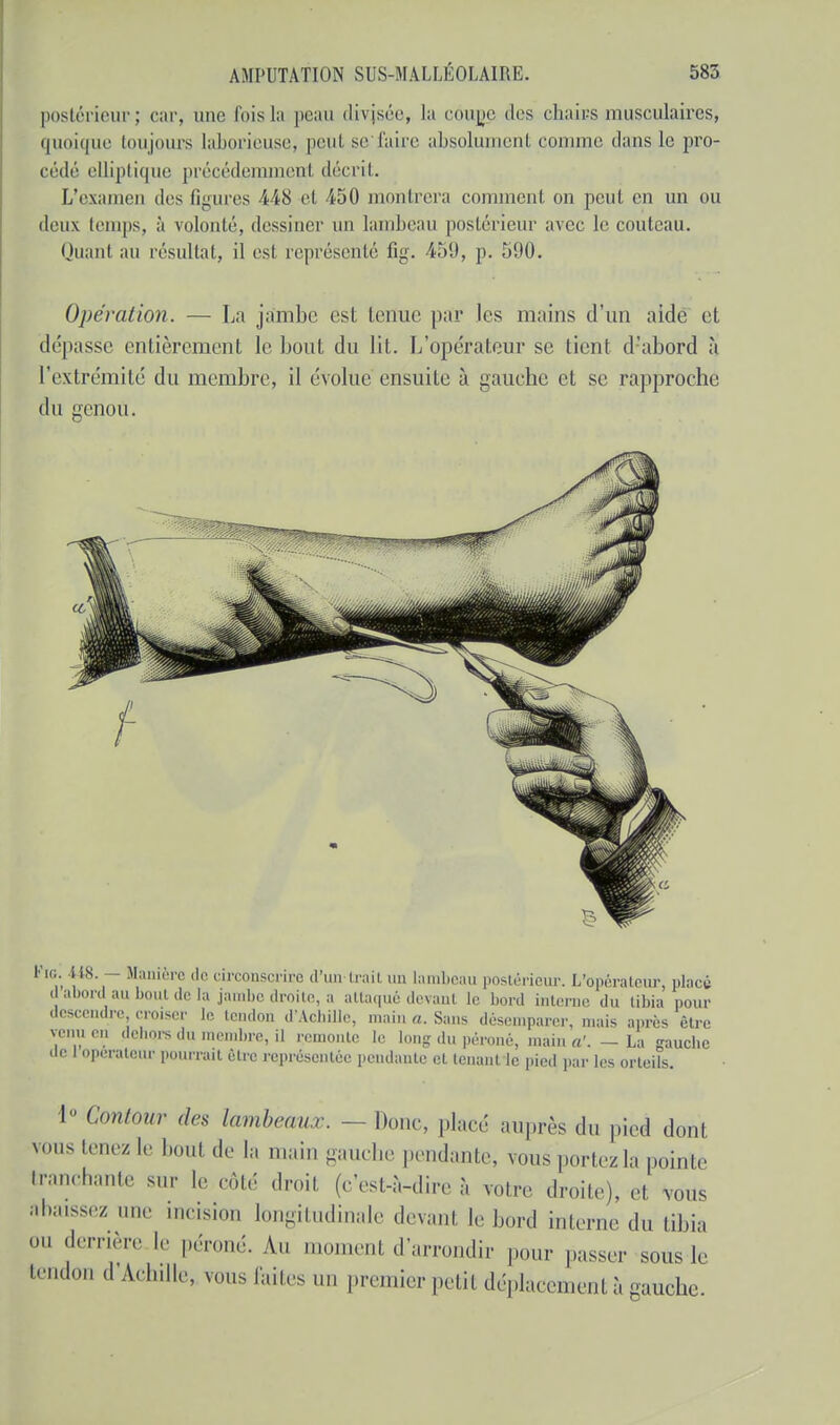 postérieur; car, une l'ois lu peau divisée, La côuge des chaics musculaires, quoique toujours laborieuse, peut sefaire absolument comme dans le pro- cédé elliptique précédemment décrit. L'examen des Bgures 448 et 450 montrera comment on peut en un ou deux temps, à volonté, dessiner un lambeau postérieur avec le couteau. Quant au résultat, il est représenté fig. 450, p. 590. Opération. — La jambe est tenue par les mains d'un aide et dépasse entièrement le bout du lit. L'opérateur se tient d'abord à l'extrémité du membre, il évolue ensuite à gauche et se rapproche du genou. l'ic. lis. — Manière de circonscrire d'un trait un lambeau postérieur. L'opérateur pincé d abord au bout de la jambe droite, a attaqué rant le bord interne du tibia pour descendre, croiser le tendon d'Achille, main a. Sans désemparer, mais après être venu on dehors du membre, il remonte le long du péroné, main a'. — La gauche de 1 operateur pourrait être représentée pendante et tenant le pied par les orteils. 1 Contour des lambeaux. - - Donc, placé auprès du pied dont vous tenez le bout de la main gauche pendante, vous portez la pointe tranchante sur le côté droit (c'est-à-dire à votre droite), et vous abaissez une incision longitudinale devant le bord interne du tibia ou !*erère le péroné. An moment d'arrondir pour passer sous le tendon d Achille, vous Paites un premier petit déplacement à gauche.