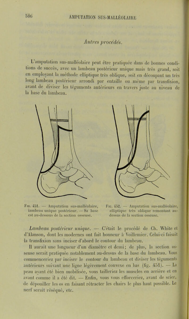 A ulres procédés. L amputation sus-malléolaire peut être pratiquée dans de bonnes condi- tions de succès, avec nu lambeau postérieur unique mais 1res grand, soit en employant la méthode elliptique très oblique, soit en découpant un très long lambeau postérieur arrondi par entaille ou même par transh'xion, avant de diviser les téguments antérieurs en travers juste au niveau de la base du lambeau. Fig. 451. —■ Amputation sus-malléolaire, iamb'eau unique postérieur. — Sa base est au-dessous de la section osseuse. Fie. 452. — Amputation sus-malléolaire, elliptique dès oblique remontant un- dessus de ht section osseuse. Lambeau postérieur unique. — C'était le procédé de Ch. White Cl d'Alanson, dont les modernes ont fait honneur à Voillemier. Celui-ci faisait la translixion sans inciser d'abord le contour du lambeau. ïï aurait une longueur d'un diamètre et demi ; de plus, la section os- seuse serait pratiquée notablement au-dessus de la base du lambeau. Vous commenceriez par inciser le contour du lambeau et diviser les téguments antérieurs suivant une ligne légèrement convexe eu lias (fig. 151). — La peau ayant été bien mobilisée, -vous tailleriez les muscles en arrière et en avant comme il a été dit. — Enfin, vous vous efforceriez, avant de scier, di' dépouiller les os en faisant rétracter les chairs le plus liant possible. Le nerf serait réséqué, etc.