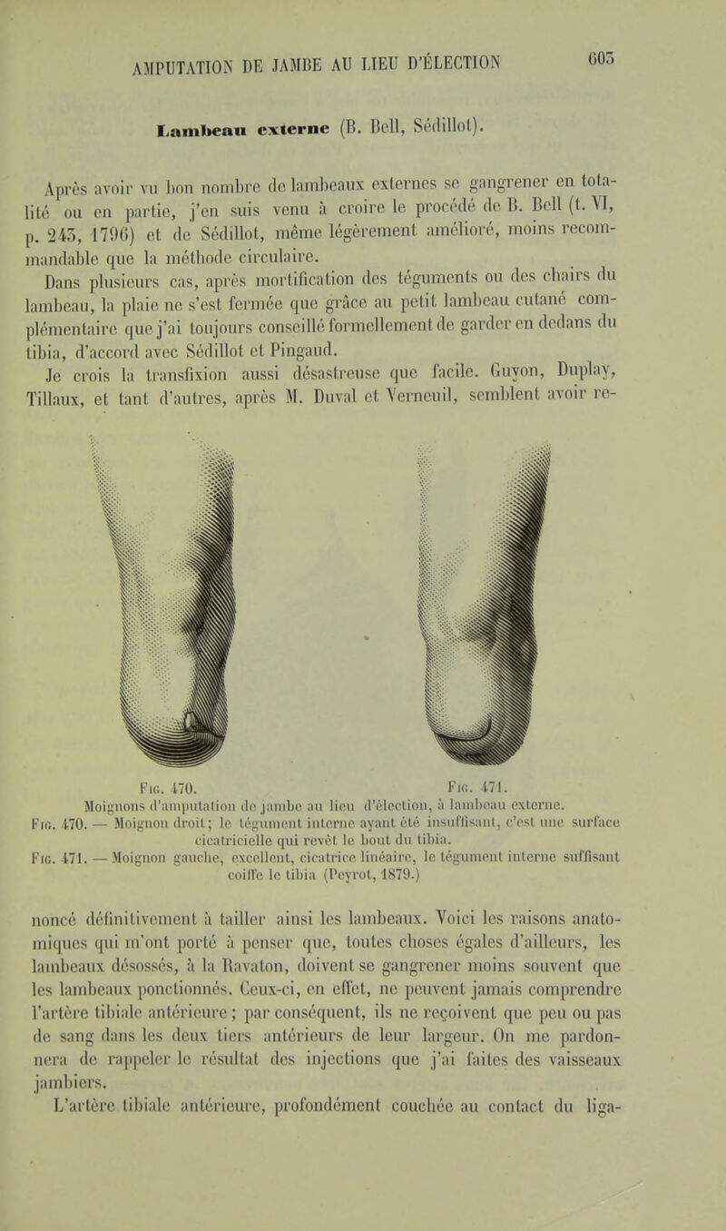 Lambeau externe (B. Bell, Sédillot). Après avoir vu bon nombre de lambeaux externes se gangrener en tota- lité ou en partie, j'en suis venu à croire le procédé de B. Bell (t. VI, p. 243, 1796) et de Sédillot, même légèrement amélioré, moins recom- mandable que la méthode circulaire. Dans plusieurs cas, après mortification des téguments ou des chairs du lambeau, la plaie ne s'esl fermée que grâce au petit lambeau cutané com- plémentaire que j'ai toujours conseillé formellement de garder en dedans du tibia, d'accord avec Sédillol et Pingaud. Je crois la transfixion aussi désastreuse que facile. Guyon, Duplay, Tillaux, cl tant d'autres, après M. Duval et Verneuil, semblenl avoir re- Fin. 170. Fin. 471. Moignons d'amputation de jambe an lieu d'élection, à lambeau externe. Fie. 470.— Moignon droit; le tégument interne ayant été insuffisant, c'est une surface cicatricielle qui revêt le bout du tibia. Fie 171. — Moignon gauche, excellent, cicatrice, linéaire, le tégument interne suffisant coi Ile le tibia (Peyrot, 1879.) noncé définitivement à tailler ainsi les lambeaux. Voici les raisons anato- miques qui m'ont porté à penser que, toutes choses égales d'ailleurs, les lambeaux désossés, à la Ravaton, doivent se gangrener moins souvent que les lambeaux ponctionnés. Ceux-ci, en effet, ne peuvent jamais comprendre l'artère tibiale antérieure ; par conséquent, ils nereçoivenl que peu ou pas de sang dans les deux tiers antérieurs de leur largeur. On me pardon- nera de rappeler le résultat des injections que j'ai faites (les vaisseaux jambiers. L'artère tibiale antérieure, profondément couchée au contact du liga-