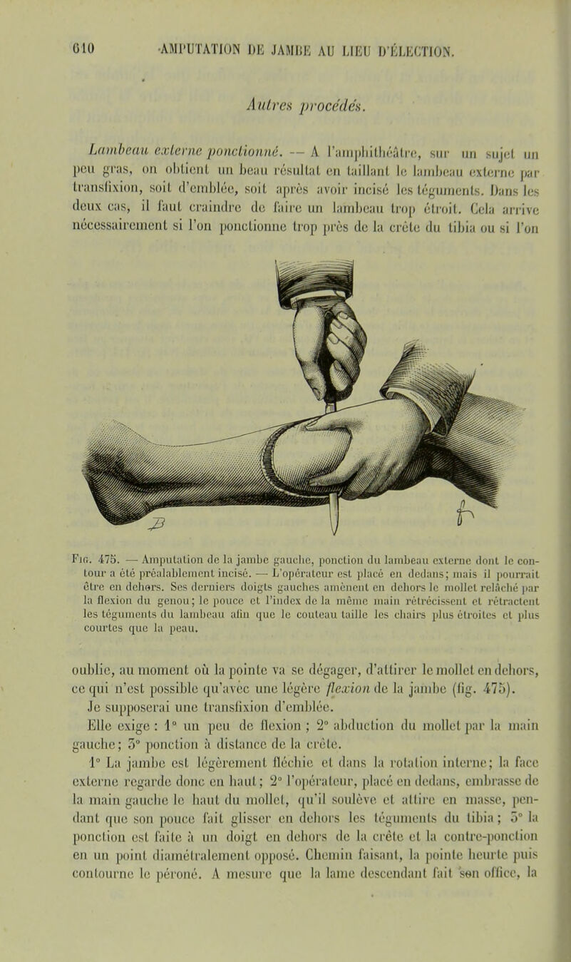 Autres procédés. Lambeau externe ponctionné. — A l'amphithéâtre, sur un sujcl un peu gras, on obtient un beau résultat en taillant le lambeau externe par transfixion, soit d'emblée, soit après avoir incisé les téguments. Dans les deux cas, il faut craindre de l'aire un lambeau trop étroit. Cela arrive nécessairement si l'on ponctionne trop près de la crête du tibia ou si l'on Fin. 475. — Amputation de là jambe gauche, ponction du lambeau externe dont le con- tour a été préalablement incisé. — L'opérateur est placé en dedans; mais il pourrait être en dehors. Ses derniers doigts gauches amènent en dehors le mollet relâché par la flexion du genou; le pouce et l'index delà même main rétrécissent et rétractent les téguments du lambeau afin que le couteau taille les chairs )>lu> étroites et plus courtes que la peau. oublie, au moment où la pointe va se dégager, d'attirer le mollet en dehors, ce: qui n'est possible qu'avec une légère flexionàe la jambe (fig. 475). Je supposerai une transfixion d'emblée. Elle exige : 1° un peu de flexion ; 2° abduction du mollet par la main gauche; 3° ponction à distance de la crête. 1° La jambe est légèrement fléchie cl dans la rotation interne; la face externe regarde donc en haut; !2° l'opérateur, placé en dedans, embrasse de la main gauche le haut du mollet, qu'il soulève et attire en niasse, pen- dant que son pouce fait glisser en dehors les téguments du tibia ; o° la ponction est faite à un doigt en dehors de la crête et la contre-ponction en un point diamétralement opposé. Chemin faisant, la pointe heurte puis contourne le péroné. A mesure que la lame descendant fait s«n office, la