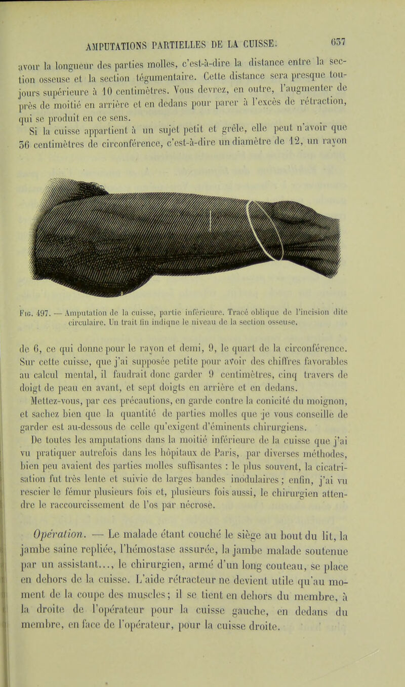 avoir ta longueur des parties molles, c'est-à-dire la distance entre la sec- tion osseuse el la section tégumentaire. Cette distance sera presque ton- jours supérieure à 10 centimètres. Vous devrez, en outre, l'augmenter de près de moitié en arrière el en dedans pour parer à l'excès de rétraction, qui se produit en ce sens. Si la cuisse apparlieul à un sujet petit et grêle, elle peul n'avoir que 56 centimètres de circonférence, c'est-à-dire un diamètre de 12, un rayon Fio. 197. — Amputation de la cuisse, partie inférieure. Tracé oblique de l'incision dite circulaire. Un trait Qn indique le niveau de la section osseuse. de fi, ce qui donne pour le rayon et demi, 9, le quarl de la circonférence. Sur cette cuisse, que j'ai supposée pelile pour avoir des chiffres favorables au calcul mental, il faudrait donc garder il centimètres, cinq travers de doigt de peau en avant, et sept doigts en arrière cl en dedans. Mettez-vous, par ces précautions, en garde contre la conicilé du moignon, el sachez bien que la quantité de parties molles que je vous conseille de garder est au-dessous de celle qu'exigent d'éminents chirurgiens. De toutes les amputations dans la moitié inférieure de la cuisse que j'ai vu pratiquer autrefois dans les hôpitaux de. Paris, par diverses méthodes, bien peu avaienl îles parties molles suffisantes : le plus souvent, la cicatri- sation fut très lente et suivie de larges Landes modulaires; enfin, j'ai vu rescier le fémur plusieurs fois et, plusieurs fois aussi, le chirurgien atten- dre le raccourcissement de l'os par nécrosé. Opéra/ion. ■— Le malade étant couché le siège au bout du lit, la jambe saine repliée, l'hémostase assurée, la jambe malade soutenue par un assistant..., le chirurgien, armé d'un long couteau, se place en dehors de la cuisse. L'aide rétracteur ne devient utile qu'au mo- ment de la coupe des muscles; il se tient en dehors du membre, à la droite de l'upéraleur pour la cuisse gauche, en dedans du membre, en l'ace de l'opérateur, pour la cuisse droite.