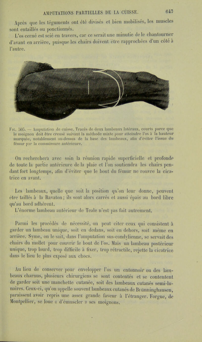 Après que les téguments ont été divisés et bien mobilisés, les muscles sont entaillés ou ponctionnés. L'os cerné esl scié en travers, car ce serait une minutie de le chantourner d'avant en arrière, puisque les chairs doivent être rapprochées d'un côté à l'autre. Fie. bOÔ. — Amputation de cuisse. Tracés do deux lambeaux latéraux, courts parce que le moignon doit être creusé suivant ta méthode mixte pour atteindre l'os il la hauteur marquée, notablement au-dessus de la base des lambeaux, alin d'éviter l'issue du fémur par la commissure antérieure, On recherchera avec soin la réunion rapide superficielle et profonde de tonte la partie antérieure delà plaie et l'on soutiendra les chairs pen- dant fort longtemps, afin d'éviter que le bout du fémur ne rouvre la cica- trice en avant. Les lambeaux, quelle que soit, la position qu'on leur donne, peuvent être taillés à la Kavalon; ils sont alors carrés cl aussi épais au bord libre qu'au bord adhérent. L'énorme lambeau antérieur de Tcale n'est pas fait autrement. Parmi les procédés de nécessité, ou peut citer ceux qui consistent à garder un lambeau unique, soiI en dedans, soiI en dehors, soit même en arrière. S wne, on le sait, dans l'amputat ion sus-condylienne, se servait des chairs du mollet pour couvrir le bout de L'os. .Mais un lambeau postérieur unique, trop lourd, trop difficile à fixer, trop rétractile, rejette La cicatrice dans le lieu le plus exposé aux chocs. Au Lieu de conserver pour envelopper L'os un entonnoir ou des lam- beaux charnus, plusieurs chirurgiens se sont contentés et se contentent de garder soit une manchette cutanée, soit dos lambeaux cutanés semi-lu- naires. Ceux-ci, qu'on appelle souvent lambeaux cutanés de Bi tinninghausen, paraissent avoir repris une assez grande laveur à l'étranger. l'orgue, de Montpellier, se loue « d'émuscler » ses moignons.