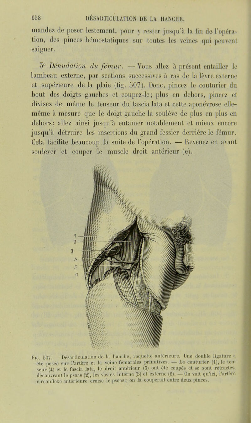 mandez do poser lestement, pour y rester jusqu'à la fin de l'opéra- tion, des pinces hémostatiques sur toutes les veines qui peuvent ligner. 3° Dénudalion du fémur. — Vous allez à présent entailler le lambeau externe, par sections successives à ras de la lèvre externe et supérieure de la plaie (fig. 507). Dune, pincez le couturier du bout des doigts gauches et coupez-le; plus en dehors, pincez el divisez de même le tenseur du fascia lata et celle aponévrose elle- même à mesure que le doigl gauche la soulève de plus en plus en dehors; allez ainsi jusqu'à entamer notablement el mieux encore jusqu'à détruire les insertions du grand fessier derrière le fémur. Cela facilite beaucoup la suite de, l'opération. — Revenez en avant soulever et couper le muscle droit antérieur (e). Fig. 507. — Désarticulation de la Louche, raquette antérieure. Une double ligature ■ été posée sur l'artère et la veine fémorales primitives. — Le couturier (1), le ten- seur (i) et le fascia lata, le droit antérieur (5) ont été coupes cl se son! rétractés, découvrant le psoas (2), les vastes interne (5) et externe (6). — On voit qu'ici, l'artère circonflexe antérieure croise le psoas; on la couperait entre deux pinces.