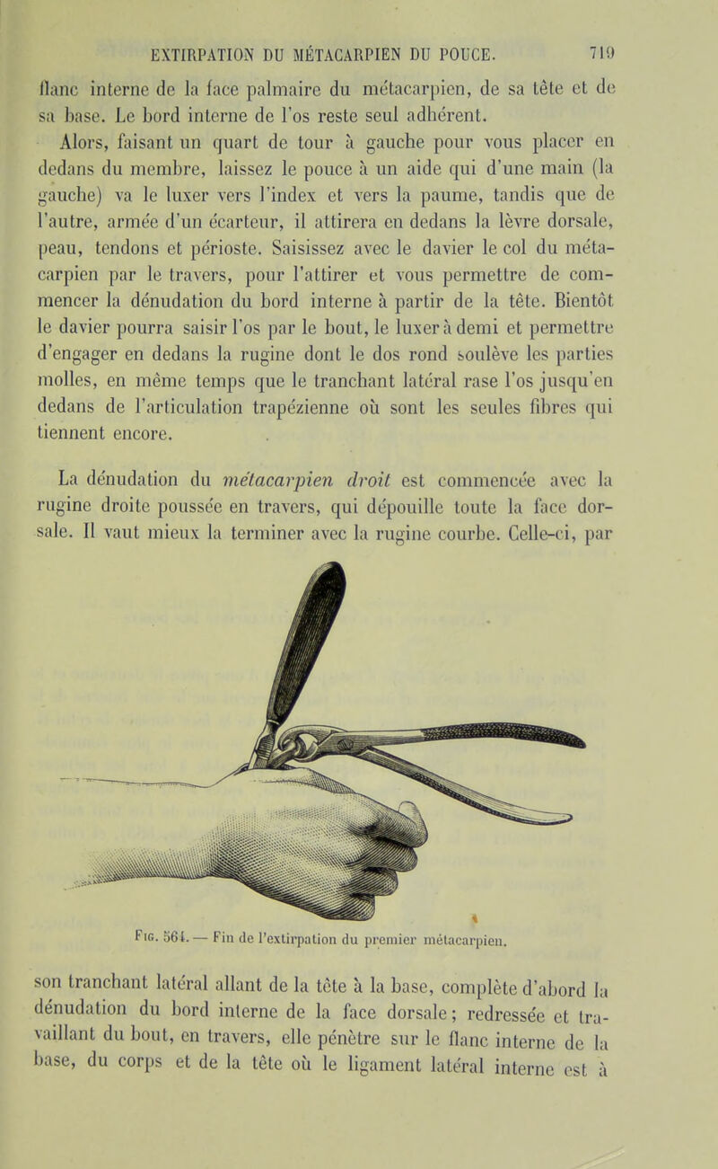 lïanc interne de la face palmaire du métacarpien, de sa tête et de sa base. Le bord interne de l'os reste seul adhérent. Alors, faisant un quart de tour à gauche pour vous placer en dedans du membre, laissez le pouce à un aide qui d'une main (la gauche) va le luxer vers l'index et vers la paume, tandis que de l'autre, armée d'un écarteur, il attirera en dedans la lèvre dorsale, peau, tendons et périoste. Saisissez avec le davier le col du méta- carpien par le travers, pour l'attirer et vous permettre de com- mencer la dénudation du bord interne à partir de la tête. Bientôt le davier pourra saisir l'os par le bout, le luxer à demi et permettre d'engager en dedans la rugine dont le dos rond soulève les parties molles, en même temps que le tranchant latéral rase l'os jusqu'en dedans de l'articulation trapézienne où sont les seules fibres qui tiennent encore. La dénudation du métacarpien droit est commencée avec la rugine droite poussée en travers, qui dépouille toute la face dor- sale. Il vaut mieux la terminer avec la rugine courbe. Celle-ci, par FiG. 564.— Fin de l'extirpation du premier métacarpien. son tranchant latéral allant de la tète à la base, complète d'abord la dénudation du bord interne de la face dorsale ; redressée et tra- vaillant du bout, en travers, elle pénètre sur le flanc interne de la base, du corps et de la tête où le ligament latéral interne est à