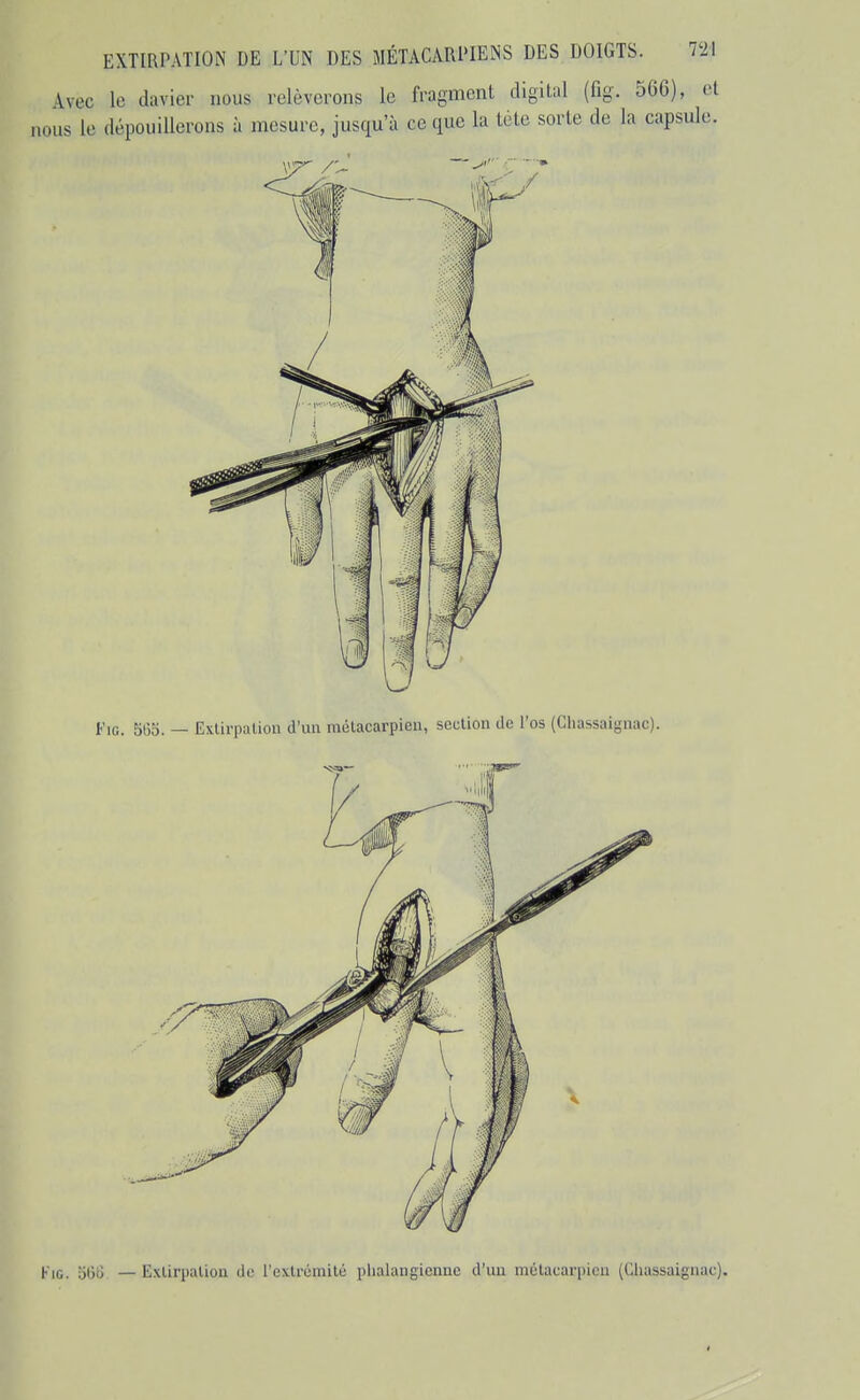 Avec le davier nous relèverons le fragment digital (fig. 566), et nous le dépouiUerons à mesure, jusqu'à ce que la tète sorte de la capsule. Fig. 56o. — Exlirpaliou d'un métacarpien, seclion de l'os (Chassaignac). KiG. 5(jrJ —Exlirpalion de l'cxlrémité plialangiennc d'un mélacarpicn (Chassaignac).