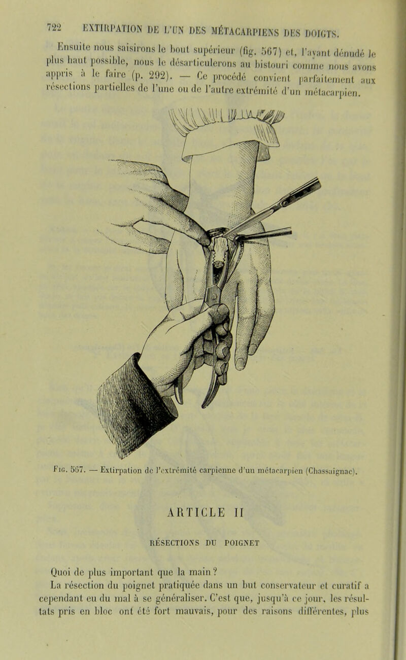 Ensuite nous saisirons le houl supérieur (firr. el. I:.v:.nt (L'-nud.- Je plus haut possible, nous le désarticulerons au histo.iri conunc; nous avons appris à le faire (p. 292). - Ce procédé convient parfaiten.cnl aux resections partielles de l'une ou de l'autre extrémité d'un inélacar])ien FiG. 567. — Exlirpalion de J'oxtrémité carpienne d'uu métacarpien (Cliassaignac). ARTICLE II RESECTIONS DU POIGNET Quoi de plus important que la main ? La résection du poignet pratiquée dans un but conservateur et curatif a cependant eu du mal à se généraliser. C'est que, jusqu'à ce jour, les résul- tats pris en bloc ont été fort mauvais, pour des raisons dillérentes, plus