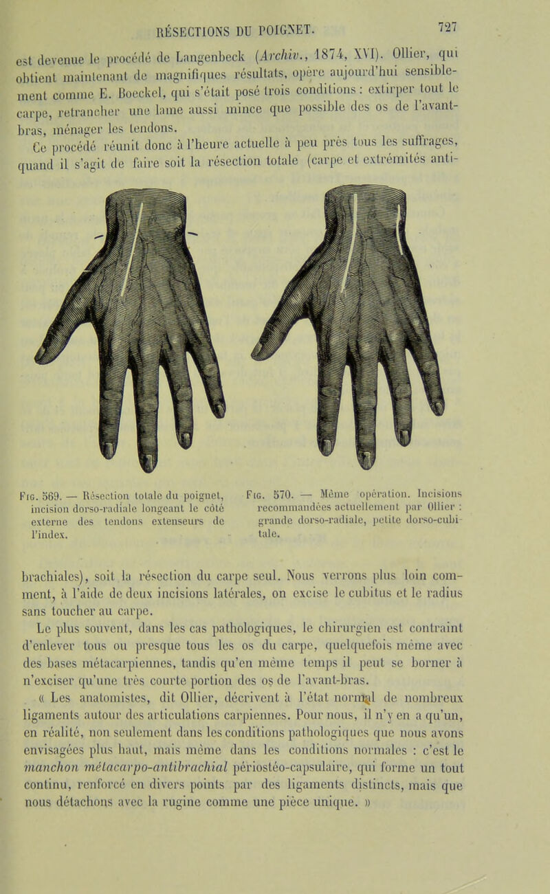 est devenue le procédé de Langenbeck (Archiv., 1874, XVI). Ollier, qui obtient niainlenant de magnifiques résultats, opère aujourd'hui sensible- ment comme E. Boeckol, qui s'était posé trois conditions: extirper tout le carpe, retrancher une lame aussi mince que possible des os de l'avant- bras, ménager les tendons. Ce procédé réunit donc à l'heure actuelle à peu près tous les suffrages, ouand il s'agit de faire soit la résection totale (carpe et extrémités anti- FiG. 569. — Réseelioii lolalc du poigiicl, incision dorso-riulialc longeant le côte externe des tendons extenseurs de l'index. FiG. 570. — Même opération. Incisions recommandées actuellement par Ollier : grande dorso-radiale, iiclite dorso-cubi laie. brachiales), soit la résection du carpe seul. Nous verrons plus loin com- ment, à l'aide de deux incisions latérales, on excise le cubitus elle radius sans toucher au carpe. Le plus souvent, dans les cas pathologiques, le chirurgien est contraint d'enlever tous ou presque tous les os du carpe, quelquefois même avec des bases métacarpiennes, tandis qu'en même temps il peut se borner à n'exciser qu'une très courte portion des os de l'avant-bras. « Les anatoniistes, dit Ollier, décrivent à l'état nomml de nombreux ligaments autour des articulations carpiennes. Pour nous, il n'y en a qu'un, en réalité, non seulement dans les conditions pathologiques que nous avons envisagées plus haut, mais même dans les conditions normales : c'est le manchon mélacarpo-antibrachial périostéo-capsulairc, qui forme un tout continu, renforcé en divers points par des ligaments distincts, mais que nous détachons avec la rugine comme une pièce unique. »