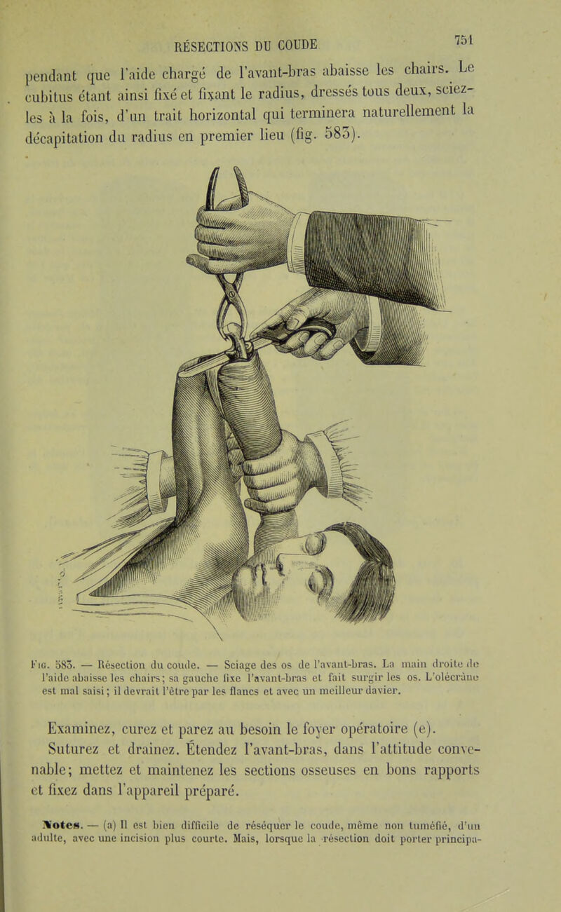 pendant que l'aide chargé de l'avant-bras abaisse les chairs. Le cubitus étant ainsi fixé et fi^fant le radius, dressés tous deux, sciez- les à la fois, d'un trait horizontal qui terminera naturellement la décapitation du radius en premier lieu (fig. 585). FiG. 583. — Résection du coiiile. — Sciage des os de l'avaiil-bras. La main droite do l'aide abaisse les chairs; sa gauche iixc l'avant-bras et fait surgir les os. L'olécràni; est mal saisi ; il devrait l'être par les flancs et avec un meilleiu- davier. Examinez, curez et parez au besoin le foyer opératoire (e). Suturez et drainez. Étendez l'avant-bras, dans l'attitude conve- nable; mettez et maintenez les sections osseuses en bons rapports et fixez dans l'appareil préparé. ^Wotes. — (a) Il est bien difficile de réséquer le coude, même non tuméfié, d'uu adulte, avec une incision plus courte. Mais, lorsque la résection doit porter principa-