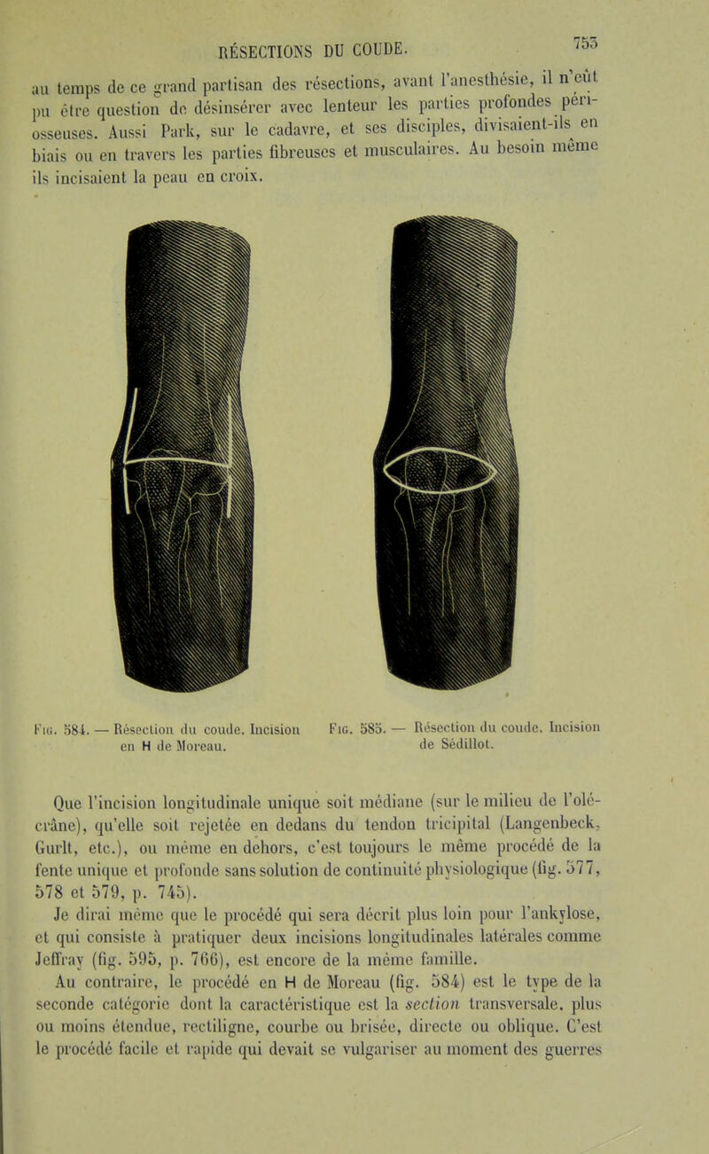 au temps de ce -rand partisan des résections, avant l'anesthésie, il n^cûl pu être question do désinsércr avec lenteur les parties profondes pen- osseuses. Aussi Park, sur le cadavre, et ses disciples, divisaient-ils en biais ou en travers les parties fibreuses et musculaires. Au besoin même ils incisaient la peau en croix. Fiti. 584. — Résecliou du coude. Incision Fie. 583. — Résection du coude. Incision en H de Moreau. de Sédillol. Que l'incision longitudinale unique soit médiane (sur le milieu de l'olc- crâne), qu'elle soit rejetée en dedans du tendon trieipital (Langenbeck- Gurlt, etc.), ou même en dehors, c'est toujours le même procédé de la fente unique et profonde sans solution de continuité physiologique (fig. 377, 578 et 579, p. 745). Je dirai même que le procédé qui sera décrit plus loin pour l'ankylose, et qui consiste à pratiquer deux incisions longitudinales latérales comme Jeffray (fig. 595, p. 766), est encore de la mémo famille. Au contraire, le procédé en H de Moreau (fig. 584) est le type de la seconde catégorie dont la caractéristique est la section transversale, plus ou moins étendue, rectiligne, courbe ou brisée, directe ou oblique. C'est le procédé facile et rapide qui devait se vulgariser au moment des guerres