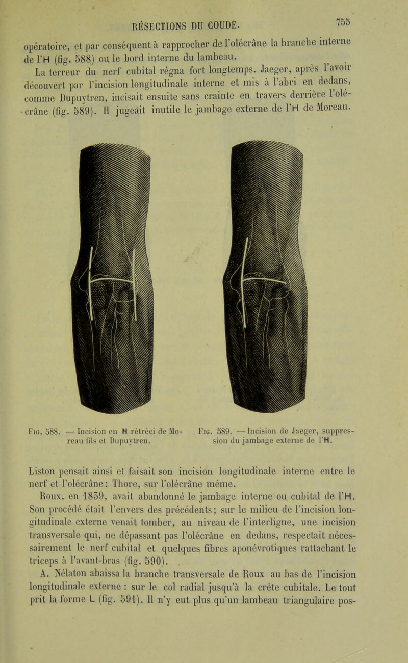 opératoire, et par conséquent à rapprocher de l'olécrâne la branche interne de l'H (fig. 588) ou le bord interne du lambeau. La terreur du nerf cubital régna fort longtemps. Jaeger, après l'avoir découvert par l'incision longitudinale interne et mis à l'abri en dedans, comme Dupuytrcn, incisait ensuite sans crainte en travers derrière l'olé- crâne (fig. 589). Il jugeait inutile le jambage externe de l'H de Moreau. Fir.. 588. — Inr.ision en H rétréci de Mo- Fiu. 589. — Incision de Jaeger, suppres- reau lils et Dupuytren. sion du jambage externe de l'H. Liston pensait ainsi et faisait son incision longitudinale interne entre le nerf et l'olécrâne : Thore, sur l'olécrâne môme. Roux, en 1859, avait abandonné le jambage interne ou cubital de l'H. Son procédé était l'envers des précédents; sur le milieu de l'incision lon- gitudinale externe venait tomber, au niveau de l'interligne, une incision transversale qui, no dépassant pas l'olécrâne en dedans, respectait néces- sairement le nerf cubital et quelques fibres aponévrotiques rattachant le triceps à l'avant-bras (fig. 590). A. Nélaton abaissa la branche transversale de Roux au bas de l'incision longitudinale externe : sur le col radial jusqu'à la crête cubitale. Le tout prit la forme L (fig. 591). 11 n'y eut plus qu'un lambeau triangulaire pos-