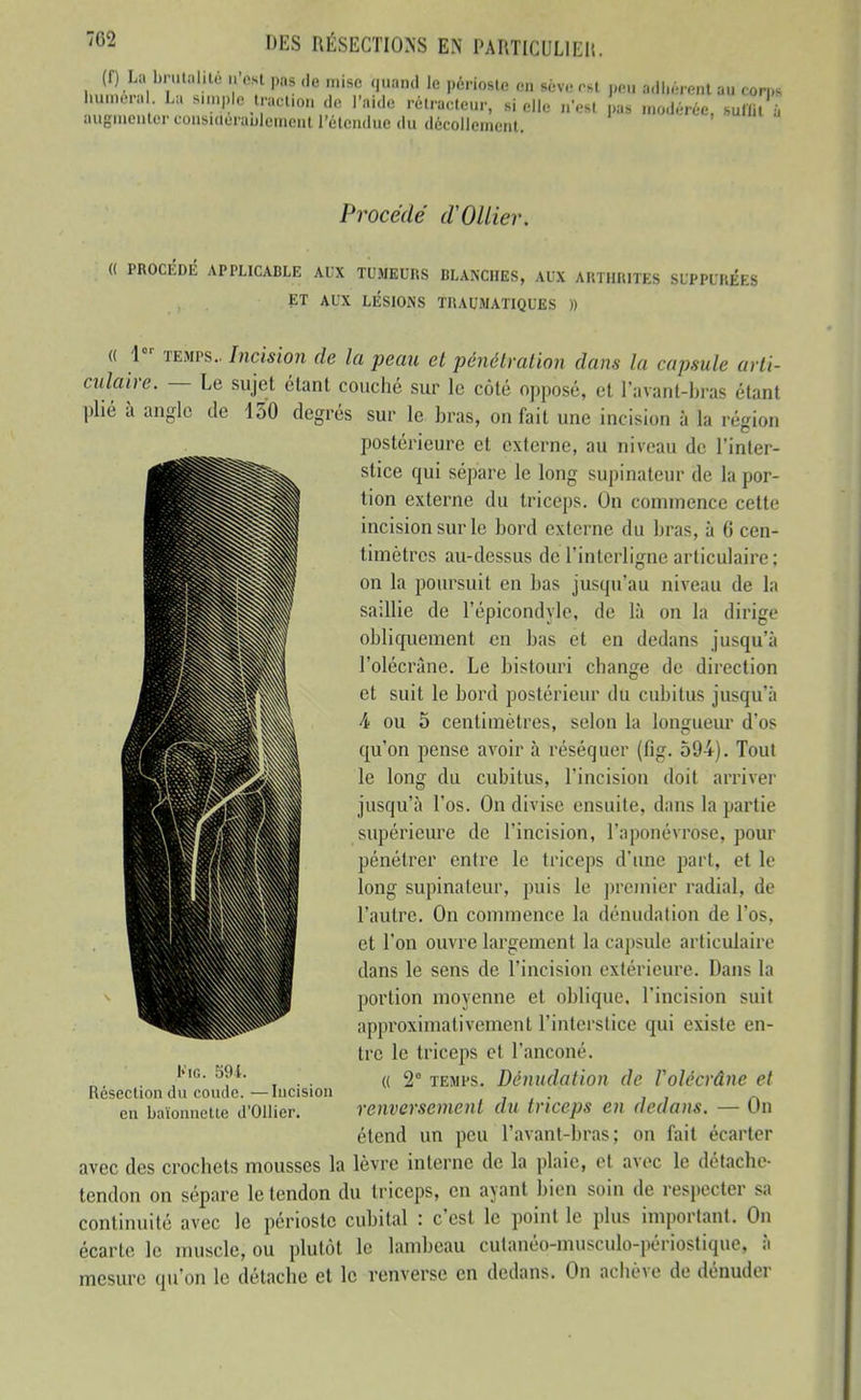 (f) La biM.tnlito n'osl ,,ns <le mise «inand le périoste en sève est peu adhérent au corps hun,era . La s.u.plo Iract.on de l'aide ré.rac.eur, si elle n'es. ,as modérée, su^t'ù augnienler cousiduraulement l'étendue du décollement. Procédé d'Ollier. « PROCÉDIÎ APPLICABLE AUX TUMEURS BLANCHES, AUX AIITIIIUTES SUPPURÉES ET AUX LÉSIONS TRAUMATIQUES )) « 1°' TEMPS.. Incision de la peau et pénétration dans la capsule arti- culaire. — Le sujet étant couché sur le côté opposé, et l'avant-bras étant plié à angle de 150 degrés sur le bras, on fait une incision à la région postérieure et externe, au niveau de l'inter- stice qui sépare le long supinateur de la por- tion externe du triceps. On commence cette incision sur le bord externe dtt bras, à G cen- timètres au-dessus de l'interligne articulaire; on la poursuit en bas jusqu'au niveau de la saillie de l'épicondyle, de là on la dirige obliquement en bas et en dedans jusqu'à l'olécràne. Le bistouri change de direction et suit le bord postérieur du cubitus jusqu'à -4 ou 5 centimètres, selon la longueur d'os qu'on pense avoir à réséquer (fig. 594). Tout le long du cubitus, l'incision doit arriver jusqu'à l'os. On divise ensuite, dans la partie supérieure de l'incision, l'aponévrose, pour pénétrer entre le triceps d'itnc part, et le long supinateur, puis le premier radial, de l'autre. On commence la dénudation de l'os, et l'on ouvre largement la capsule articulaire dans le sens de l'incision extérieure. Dans la portion moyenne et oblique, l'incision suit approximativement l'interstice qui existe en- tre le triceps et l'anconé. ({ 2° TEMPS. Dénudation de Volécrâne et renversement du triceps en dedans. — On étend un peu l'avanl-bras ; on fait écarter avec des crochets mousses la lèvre interne de la plaie, et avec le détache- tendon on sépare le tendon du triceps, en ayant bien soin de respecter sa continuité avec le périoste cubital : c'est le point le plus important. On écarte le muscle, ou plutôt le lambeau cutanéo-musculo-périostique, à mesure qu'on le détache et le renverse en dedans. On achève de dénuder iMG. m. Résection du coude. —Incision en baïonnette d'Ollier.