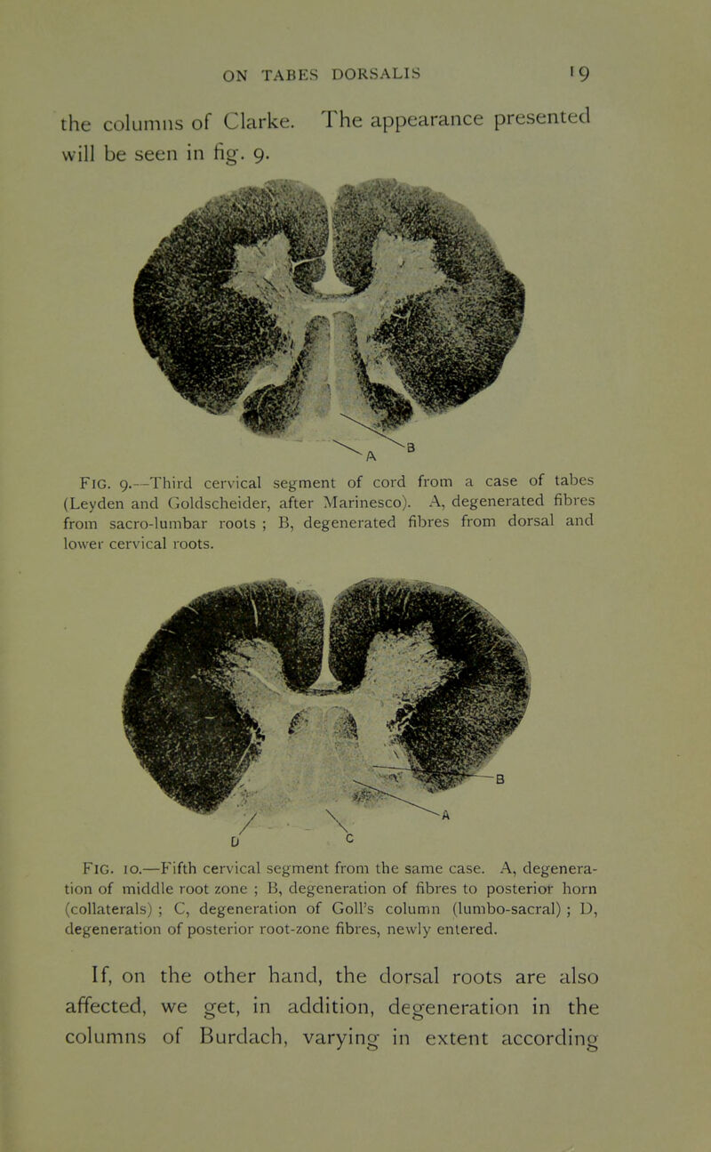 the columns of Clarke. The appearance presented will be seen in fig. 9. Fig. 9.—Third cervical segment of cord from a case of tabes (Leyden and Goldscheider, after Marinesco). A, degenerated fibres from sacro-lumbar roots ; B, degenerated fibres from dorsal and lower cervical roots. Fig. 10.—Fifth cervical segment from the same case. A, degenera- tion of middle root zone ; B, degeneration of fibres to posterior horn (collaterals) ; C, degeneration of Goll's column (lumbo-sacral); D, degeneration of posterior root-zone fibres, newly entered. If, on the other hand, the dorsal roots are also affected, we get, in addition, degeneration in the columns of Burdach, varying in extent according