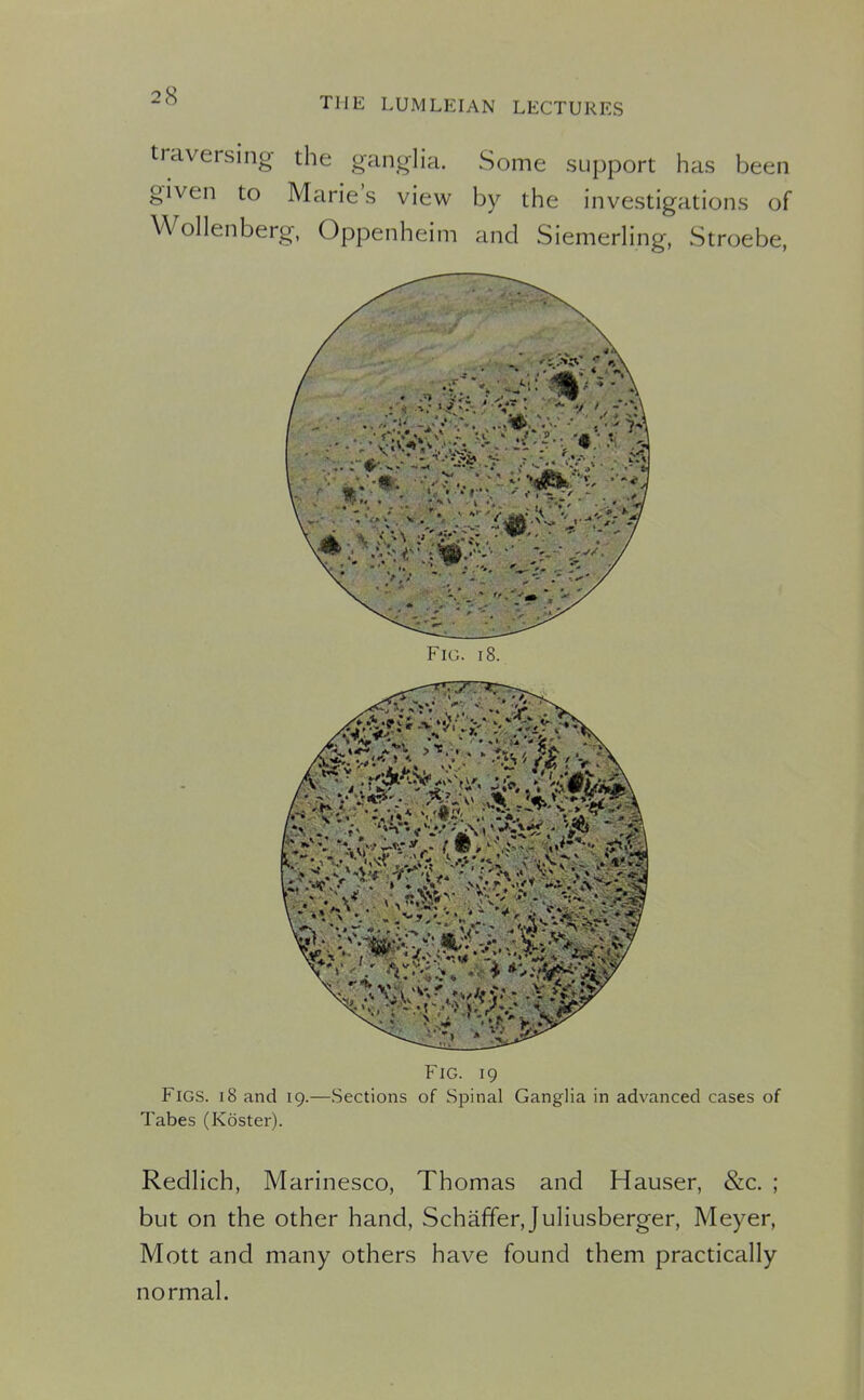 traversing the ganglia. Some support has been given to Marie's view by the investigations of Wollenberg, Oppenheim and Siemerling, Stroebe, Fig. 19 Figs. 18 and 19.—Sections of Spinal Ganglia in advanced cases of Tabes (Koster). RedHch, Marinesco, Thomas and Hauser, &c. ; but on the other hand, Schaffer, Juliusberger, Meyer, Mott and many others have found them practically normal. Al