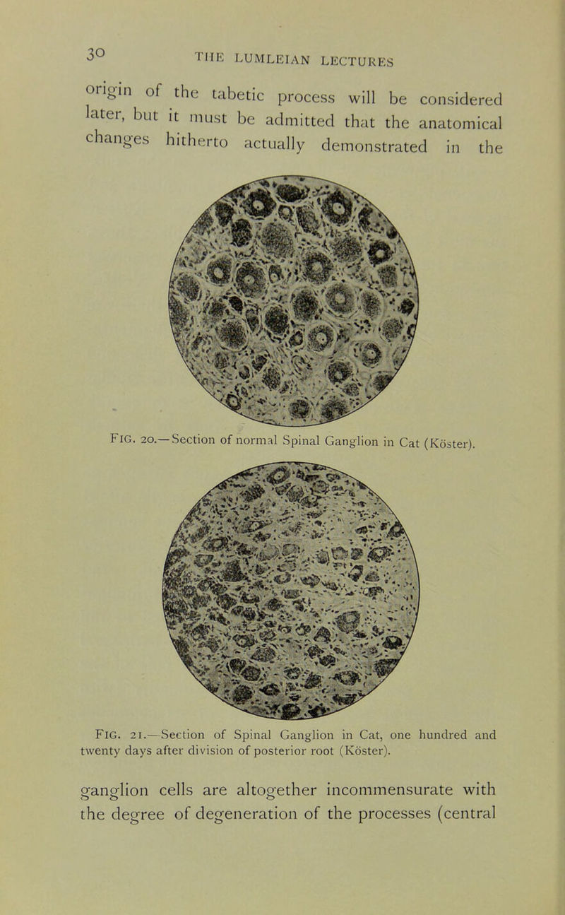 origin of the tabetic process will be considered later, but it must be admitted that the anatomical changes hitherto actually demonstrated in the Fig. 20.—Section of normal Spinal Ganglion in Cat (Koster). Fig. 21.—Section of Spinal Ganglion in Cat, one hundred and twenty days after division of posterior root (Koster). ganglion cells are altogether incommensurate with the degree of degeneration of the processes (central