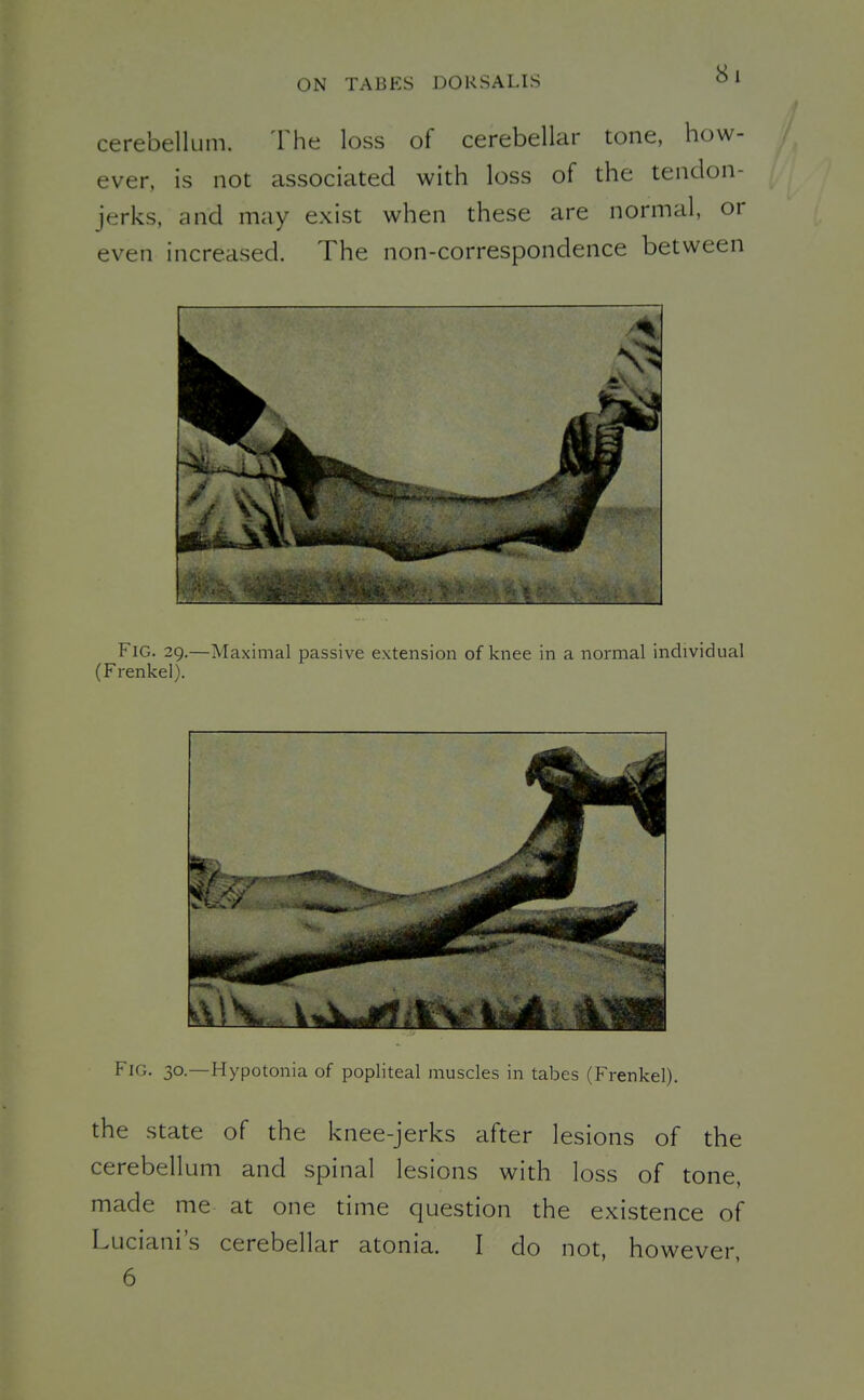 cerebellum. The loss of cerebellar tone, how- ever, is not associated with loss of the tendon- jerks, and may exist when these are normal, or even increased. The non-correspondence between Fig. 29.—Maximal passive extension of knee in a normal individual (Frenkei). Fig. 30.—Hypotonia of popliteal muscles in tabes (Frenkei). the state of the knee-jerks after lesions of the cerebellum and spinal lesions with loss of tone, made me at one time question the existence of Luciani's cerebellar atonia. I do not, however, 6