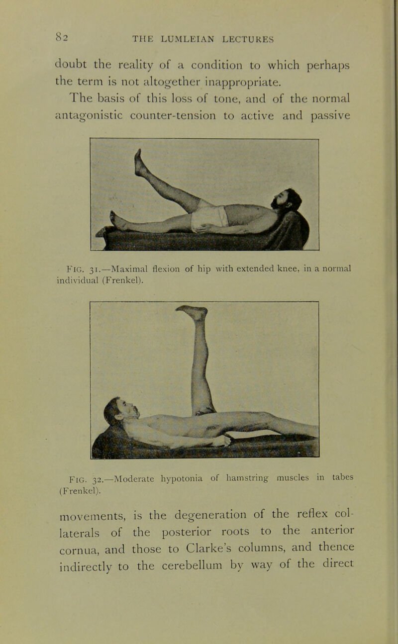 doubt the reality of a condition to which perhaps the term is not altogether inappropriate. The basis of this loss of tone, and of the normal antagonistic counter-tension to active and passive Fig. 31.—Maximal flexion of hip with extended knee, in a normal individual (Frenkel). Fig. 32.—Moderate hypotonia of hamstring muscles in tabes (Frenkel). movements, is the degeneration of the reflex col- laterals of the posterior roots to the anterior cornua, and those to Clarke's columns, and thence indirectly to the cerebellum by way of the direct