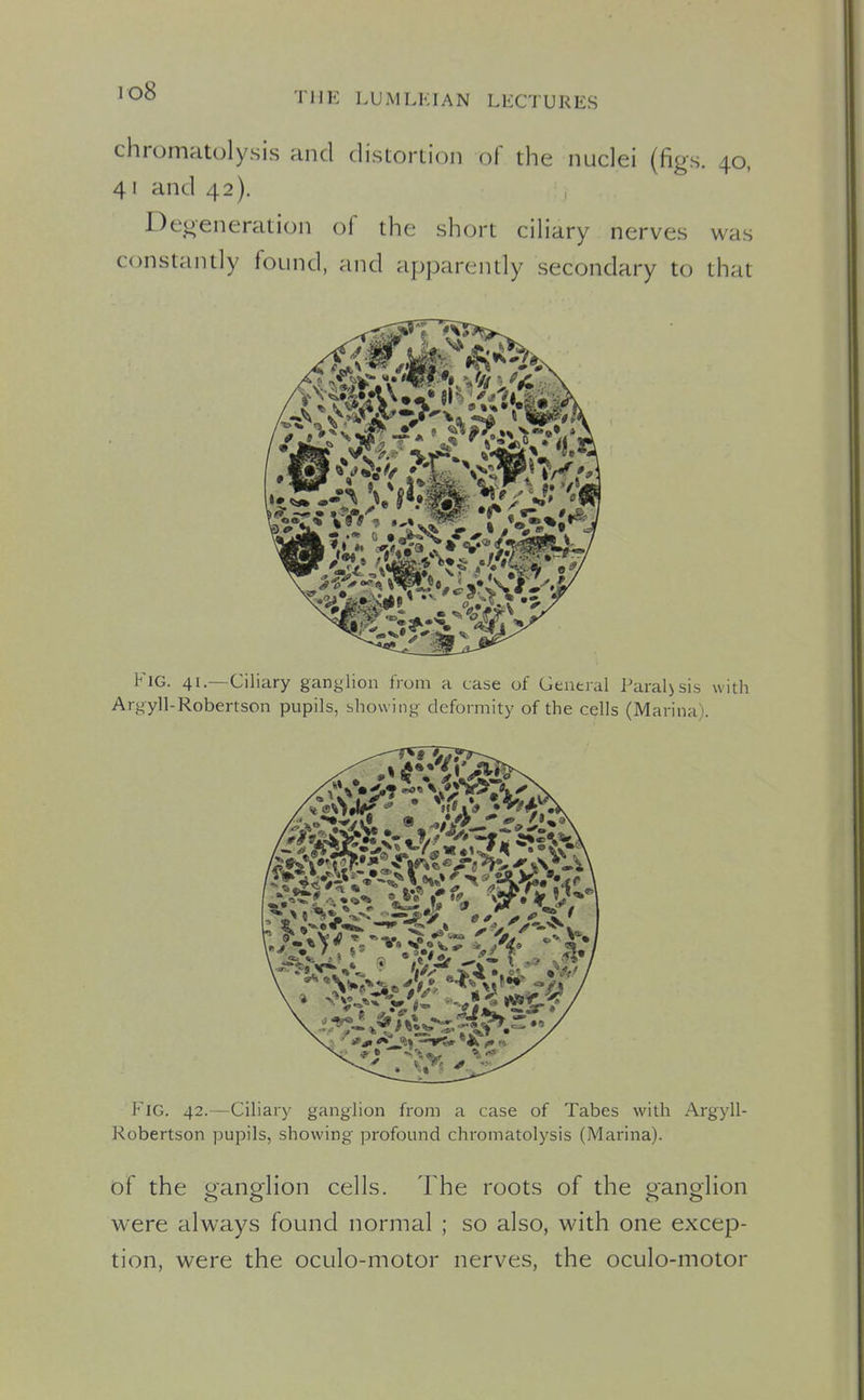 io8 chromatolysis and distortion of the nuclei (figs. 40, 41 and 42). Degeneration of the short ciliary nerves was constantly found, and apparendy secondary to that Fig. 41.—Ciliary ganglion from a case of General Paralysis with Argyll-Robertson pupils, showing deformity of the cells (Marina). Fig. 42.—Ciliary ganglion from a case of Tabes with Argyll- Robertson pupils, showing profound chromatolysis (Marina). of the oanp-lion cells. The roots of the oanoHon were always found normal ; so also, with one excep- tion, were the oculo-motor nerves, the oculo-motor