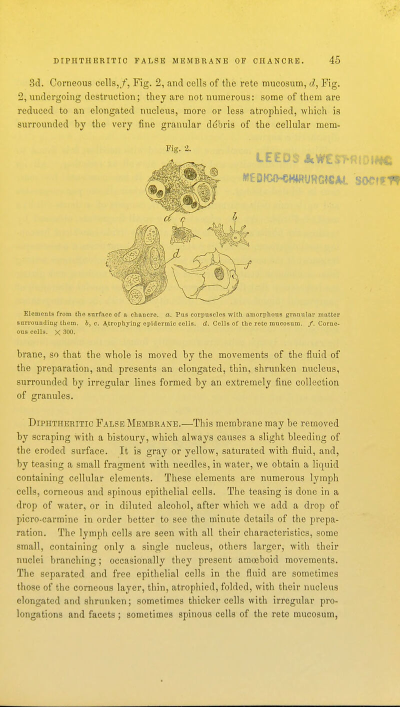 DIPHTIIERITIC FALSE MEMBRANE OF CHANCRE. 46 3d. Corneous cells,./', Fig. 2, and cells of the rete mucosum, d, Fig. 2, undergoing destruction; they are not numerous: some of them are reduced to an elongated nucleus, more or less atrophied, which is surrounded by the very fine granular ddbris of the cellular mem- Fig. 2. Elements from the surface of a chancre, a. Pas corpuscles with amorphous granular matter surrounding them. J, c. Atrophying epidermic cells, d. Cells of the rete mucosum. /. Corne- ous cells. X 300. brane, so that the whole is moved by the movements of the fluid of the preparation, and presents an elongated, thin, shrunken nucleus, surrounded by irregular lines formed by an extremely fine collection of granules. Diphtheritic False Membrane.—This membrane may be removed by scraping with a bistoury, which always causes a slight bleeding of the eroded surface. It is gray or yellow, saturated with fluid, and, by teasing a small fragment with needles, in water, we obtain a liquid containing cellular elements. These elements are numerous lymph cells, corneous and spinous epithelial cells. The teasing is done in a drop of water, or in diluted alcohol, after Avhich we add a drop of picro-carmine in order better to see the minute details of the prepa- ration. The lymph cells are seen with all their characteristics, some small, containing only a single nucleus, others larger, with their nuclei branching; occasionally they present amoeboid movements. The separated and free epithelial cells in the fluid are sometimes those of the corneous layer, thin, atrophied, folded, with their nucleus elongated and shrunken; sometimes thicker cells with irregular pro- longations and facets; sometimes spinous cells of the rete mucosum,