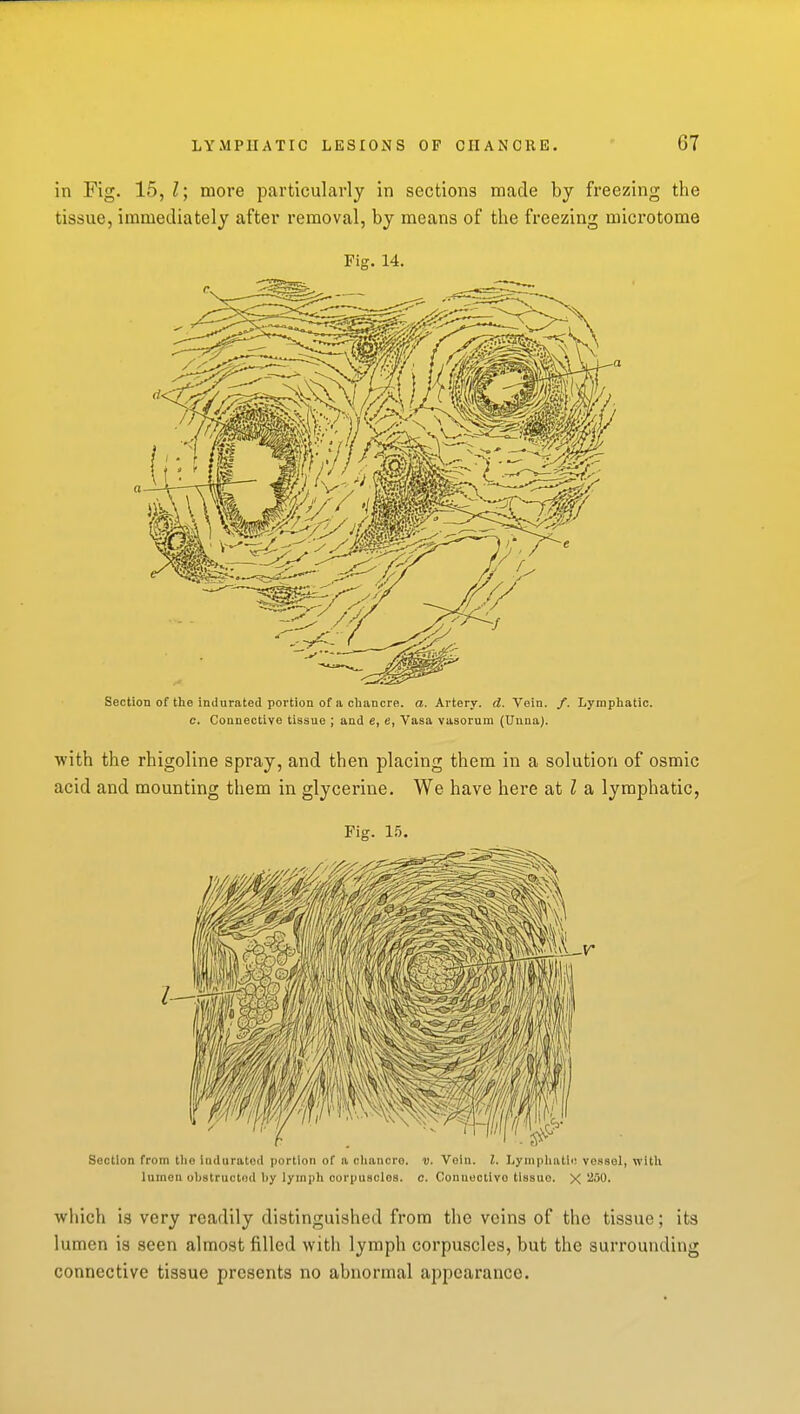 in Fig. 15, Z; more particularly in sections made by freezing the tissue, immediately after removal, by means of the freezing microtome Fig. 14. Section of the indurated portion of a chancre, a. Artery, d. Vein. /. Lymphatic, c. Connective tissue ; and e, e, Vasa vasorum (Duna). ■with the rhigoline spray, and then placing them in a solution of osmic acid and mounting them in glycerine. We have here at I a lymphatic, Fig. 15. Section from tlie indurated portion of a chaiicro. v. Vein. I. Lymphatic vessel, witli lumen obstructed by lymph corpuscles, c. Connective tissue. X ^250. Avliich is very readily distinguished from the veins of the tissue; its lumen is seen almost filled with lymph corpuscles, but the surrounding connective tissue presents no abnormal appearance.