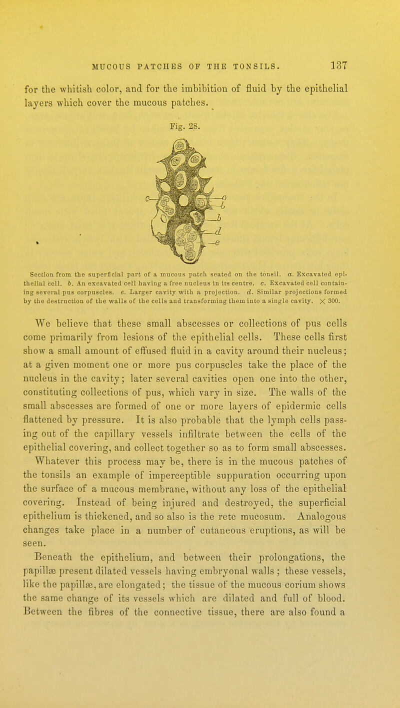 for the whitish color, and for the imbibition of fluid by the epithelial layers which cover the mucous patches. Section from the superficial part of a mucous patcli seated on the tonsil, a. Excavated epi- thelial coll. 6. An excavated cell having a free nucleus in its centre, c. Excavated cell contain- ing several pus corpuscles, e. Larger cavity with a projection. A. Similar projections formed by the destruction of the walls of the cells and transforming them into a single cavity. X 300. We believe that these small abscesses or collections of pus cells come primarily from lesions of the epithelial cells. These cells first show a small amount of effused fluid in a cavity around their nucleus; at a given moment one or more pus corpuscles take the place of the nucleus in the cavity; later several cavities open one into the other, constituting collections of pus, which vary in size. The walls of the small abscesses are formed of one or more layers of epidermic cells flattened by pressure. It is also probable that the lymph cells pass- ing out of the capillary vessels infiltrate between the cells of the epithelial covering, and collect together so as to form small abscesses. Whatever this process may be, there is in the mucous patches of the tonsils an example of imperceptible suppuration occuiTing upon the surface of a mucous membrane, without any loss of the epithelial covering. Instead of being injured and destroyed, the superficial epithelium is thickened, and so also is the rete raucosum. Analogous changes take place in a number of cutaneous eruptions, as will be seen. Beneath the epithelium, and between their prolongations, the papillae present dilated vessels liaving embryonal walls ; these vessels, like the papillae, are elongated; the tissue of the mucous coriuni shows the same change of its vessels which are dilated and full of blood. Between the fibres of the connective tissue, there are also found a